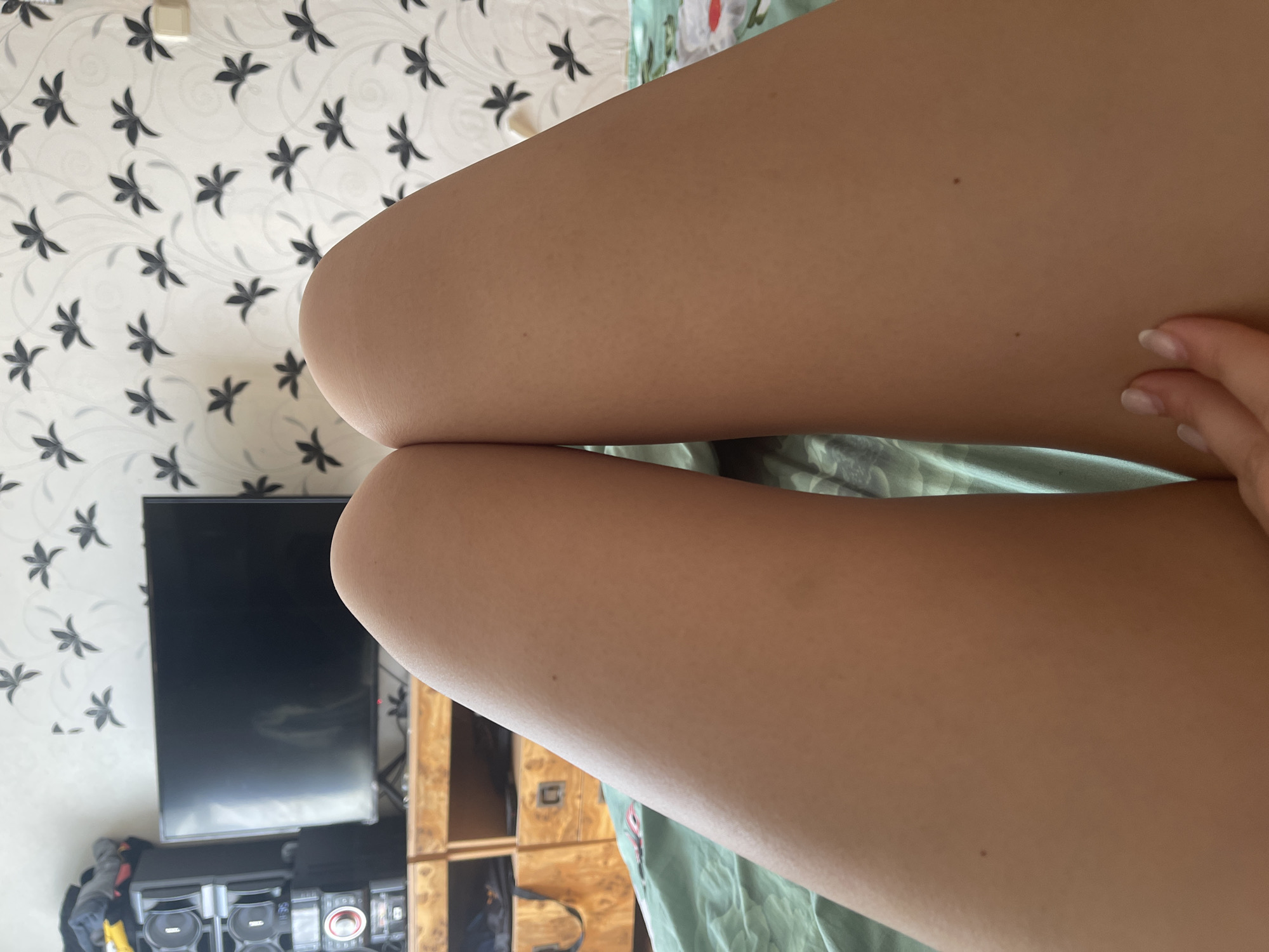 A close-up, low-angle, indoor shot focuses on the thighs of a person lying on a bed. The person's legs, positioned vertically in the frame, occupy the majority of the image. The skin appears smooth with visible pores, and a small mole is present on the right thigh. A hand with light-colored nail polish is visible in the lower right corner, gently touching the right thigh.
In the background, a wooden dresser with drawers is positioned beneath a television screen. To the left of the dresser, a black stereo system with a silver-colored front panel is stacked. The wall behind the dresser and television is decorated with a white floral wallpaper featuring a repeating pattern of black, stylized flowers. A green patterned bedsheet is visible beneath the person's legs. The scene suggests an interior domestic setting within an apartment. No specific location in Shcherbinka, Russia, can be determined from the visual information provided.