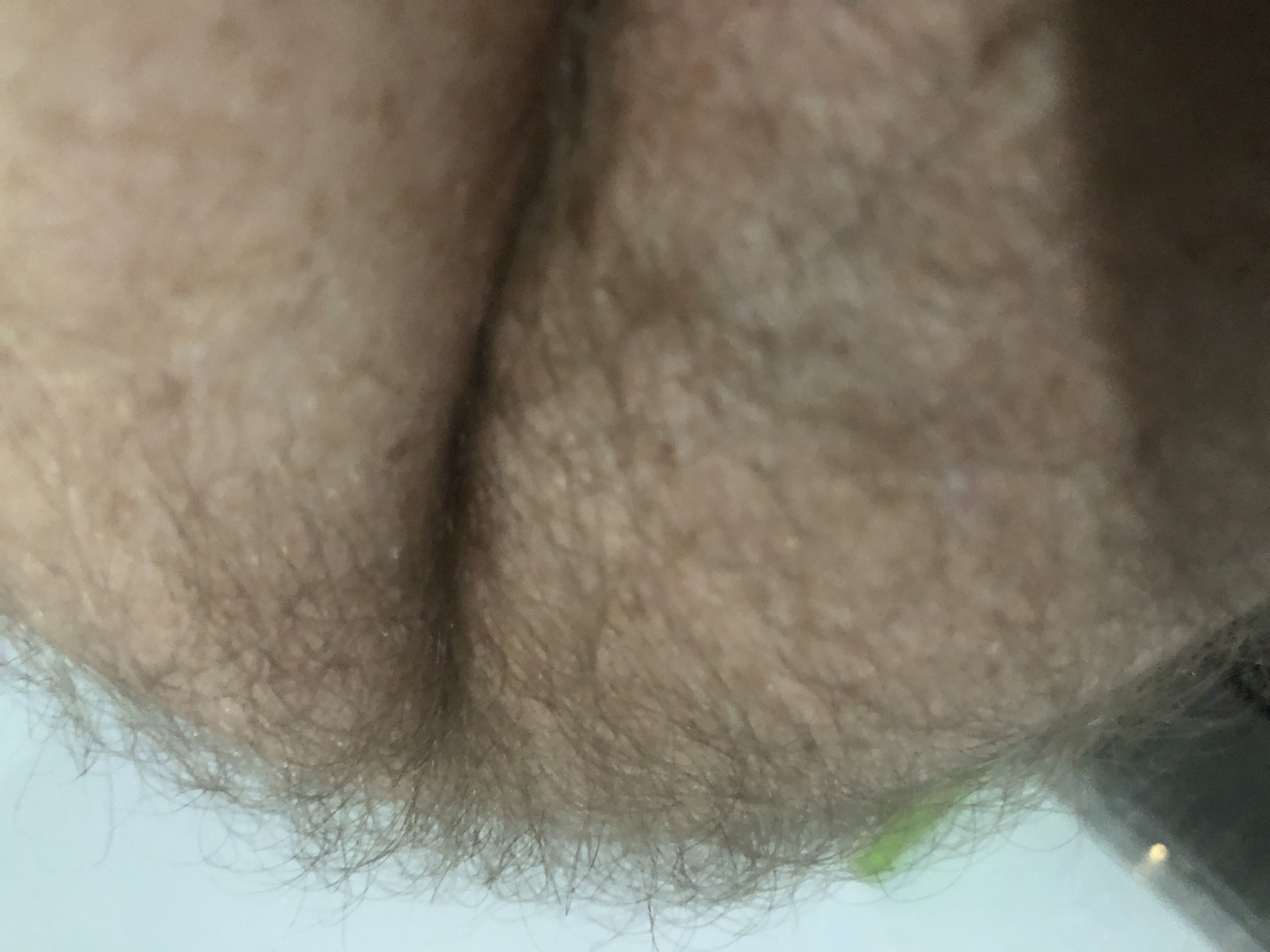 The image shows a close-up view of a hairy area, likely skin. There are no other discernible objects or people in the frame. The location is unknown.