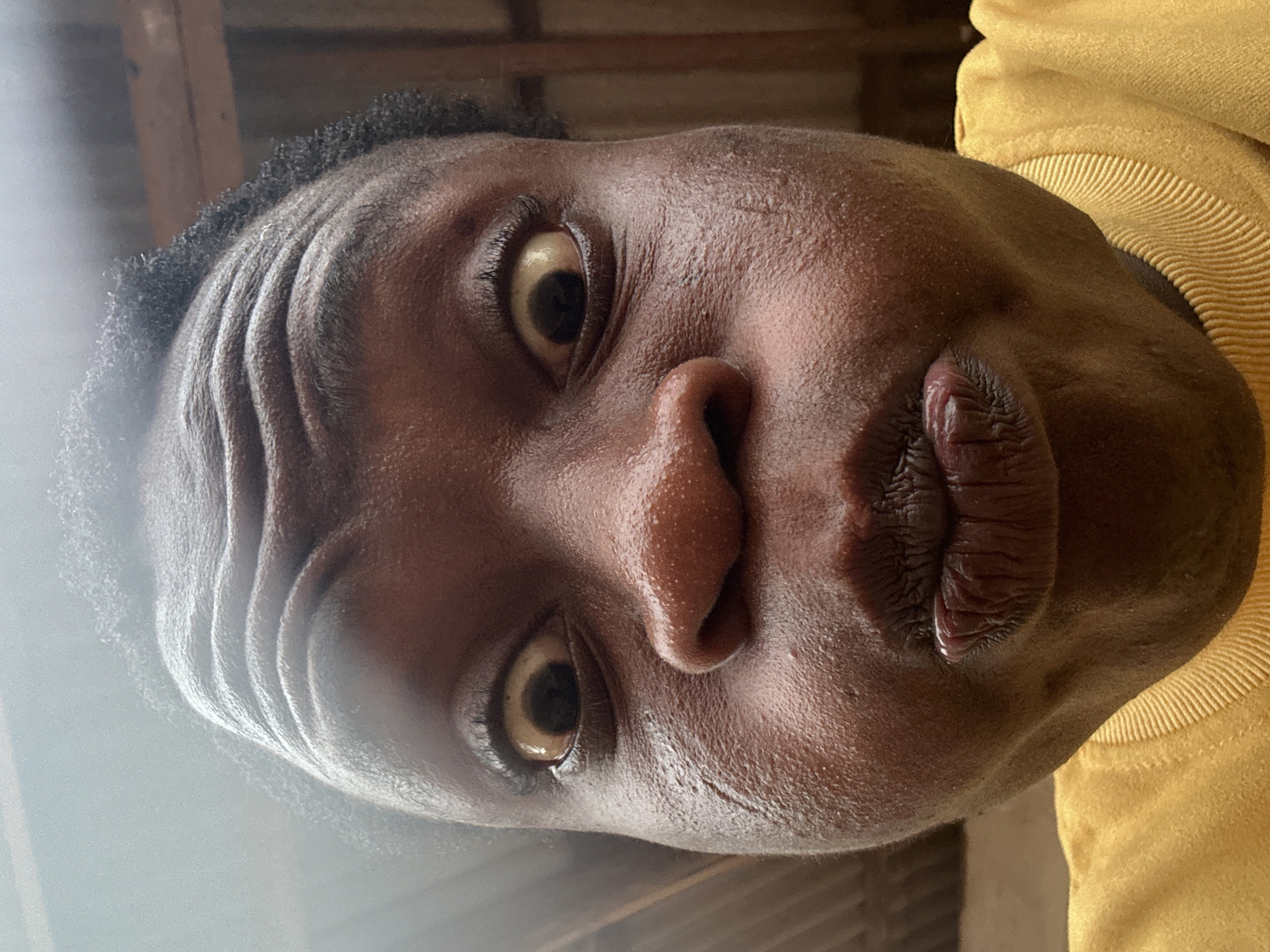A close-up, low-angle portrait captures a person with dark skin, whose head is rotated 90 degrees counter-clockwise in the frame. The subject looks directly into the camera with a wide-eyed, alert, and slightly puckered or pursed lip expression.
The person has short, dark, curly hair visible at the top of their forehead, which displays prominent horizontal wrinkles. Both eyes are wide open, and the sclera (whites of the eyes) have a noticeable yellowish tint. The skin on their face appears to have a slight sheen, possibly due to sweat or oil, emphasizing its texture. Their lips are full and distinctly textured.
Bright, natural light illuminates the subject from the left, creating highlights on the forehead and nose, and producing a soft, hazy glow on the far left side of the image. A segment of a yellow, textured garment, possibly a knitted sweatshirt, is visible on the right side of the frame, around the neck and shoulder area. The background is mostly dark and out of focus, with indistinct hints of wooden structures or beams. There is no visible text.