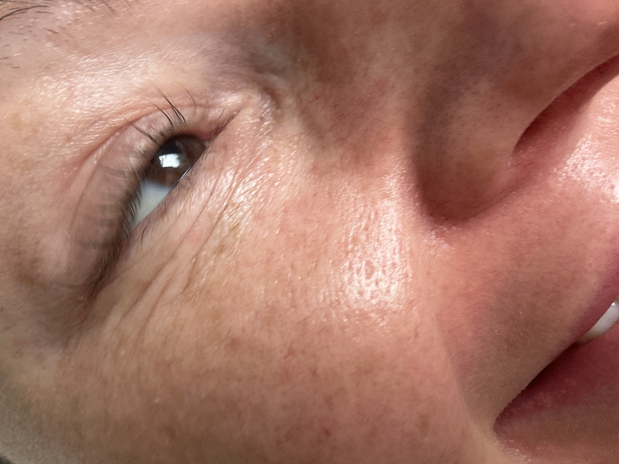The image provides an extreme close-up of the right side of a human face. The prominent subject is a dark brown eye, open with the pupil reflecting a light source. Dark eyelashes are visible along the upper lid. The skin surrounding the eye exhibits multiple fine lines, or "crow's feet," extending from the outer corner towards the temple. The skin texture across the face appears consistent, with visible pores and some minor irregularities, including small red vascular markings and a few small, pale raised bumps on the cheek area. A portion of the nose bridge and nostril is visible on the right side of the frame. In the lower left quadrant, a segment of the upper lip and a white tooth are discernable, indicating the subject is smiling or making a similar facial expression. No specific objects or environmental details are present to indicate a precise location within Tunbridge Wells, United Kingdom, or any other geographical area.