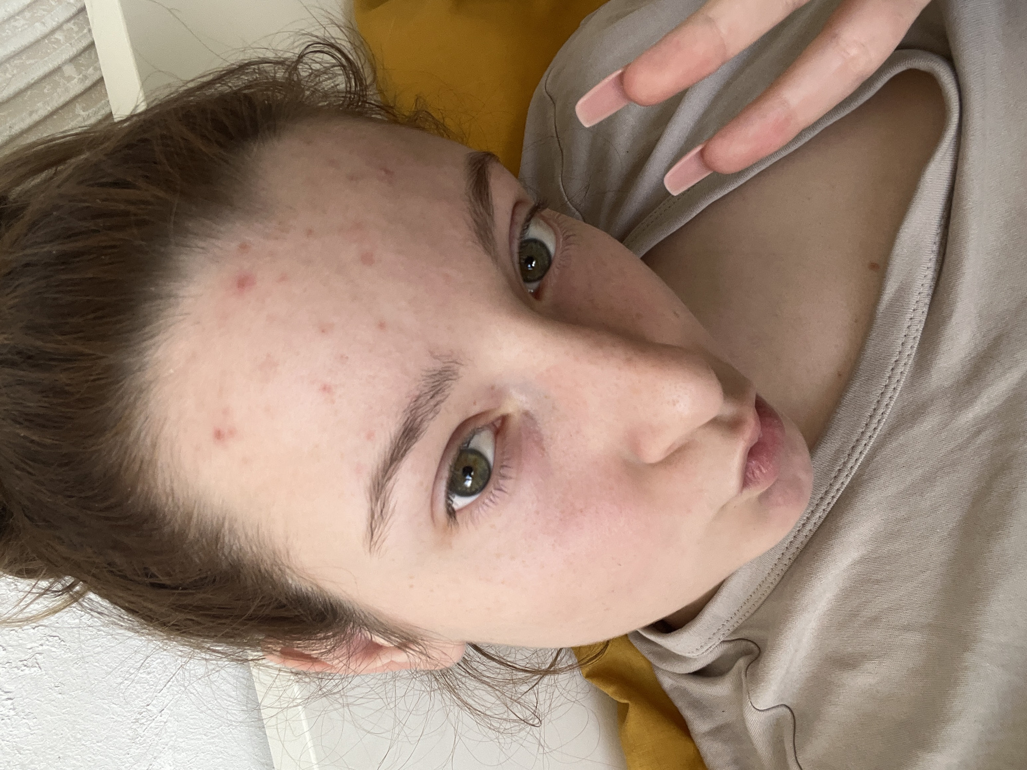 The media file presents a close-up portrait of a young woman, captured from a high angle as she lies down, giving a candid and intimate feel. Her head is tilted, and her face is the primary focus, positioned centrally and looking directly into the camera. She appears to be of fair complexion, with noticeable red blemishes or acne dots visible across her forehead and cheeks. Her eyes are a striking dark green or hazel, and her natural eyebrows are well-defined. Her light brown hair is casually styled, appearing slightly disheveled around her face and hairline. Her lips are softly pursed, contributing to a relaxed and slightly playful expression.
She is dressed in a plain, light beige or grey t-shirt or casual top. Behind her head and to her right, a vibrant yellow fabric, likely part of a pillow or bedding, adds a pop of color to the otherwise neutral background. To her left, a textured white surface, possibly a wall or headboard, is visible.
Her right hand is raised into the frame, with two fingers (index and middle) extended in a 'V' shape, commonly known as a peace sign. Her nails are conspicuously long, shaped, and painted with a subtle light pink polish. The setting appears to be indoors, most likely a bedroom, conveying a sense of informality. No text is visible in the image. The provided location context for this media is Varna, Bulgaria.