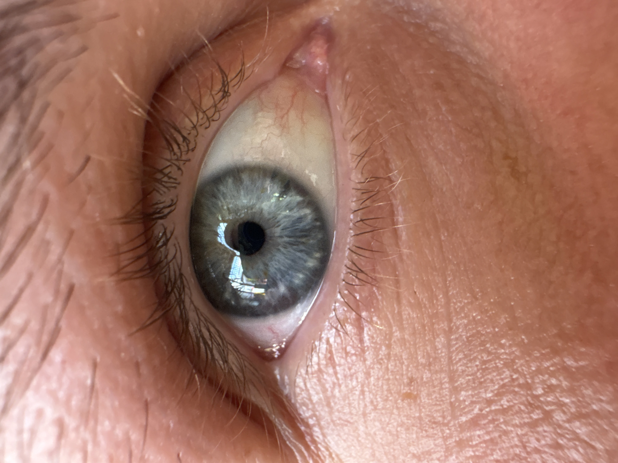 The image is a close-up, high-resolution photograph of a human eye, specifically focusing on the iris and surrounding skin. The iris is a striking light blue-gray color with darker radial lines and speckling. The pupil is a dark, circular opening in the center of the iris. Reflections of trees and buildings are visible in the pupil, suggesting an outdoor environment. The sclera, the white part of the eye, appears slightly yellowed and shows visible blood vessels, particularly in the inner corner. The skin surrounding the eye is a peachy-pink tone, with visible pores and fine lines, indicating mature skin. The eyelashes are dark and prominent. There is a small, raised, pinkish lesion on the lower eyelid, near the inner corner. The overall lighting is bright, with some specular highlights on the moist surface of the eye. There is no information in the image to indicate its location in the city of Đà Nẵng, Vietnam.