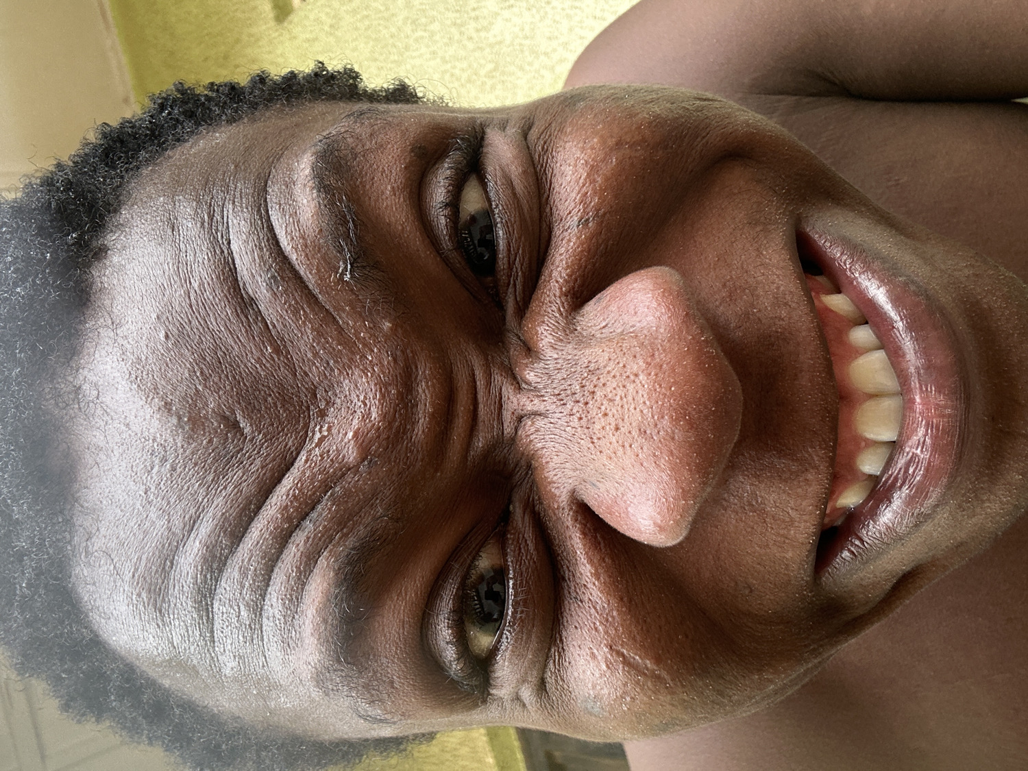 A close-up portrait features a person with dark skin, oriented horizontally with their head tilted to the right. The individual looks directly at the viewer, displaying a wide, joyful smile that reveals both upper and lower teeth. Their eyes are crinkled at the corners, and the forehead is deeply furrowed with multiple horizontal wrinkles, emphasizing an expression of strong amusement or laughter. Short, dark, curly hair frames the top and left side of their head. The skin appears somewhat dewy or shiny, particularly across the forehead and nose, where subtle texture and small bumps are visible. The background is softly blurred, showing an indistinct light greenish-yellow color. The image conveys a clear sense of happiness and mirth. No discernible clothing or text is visible.