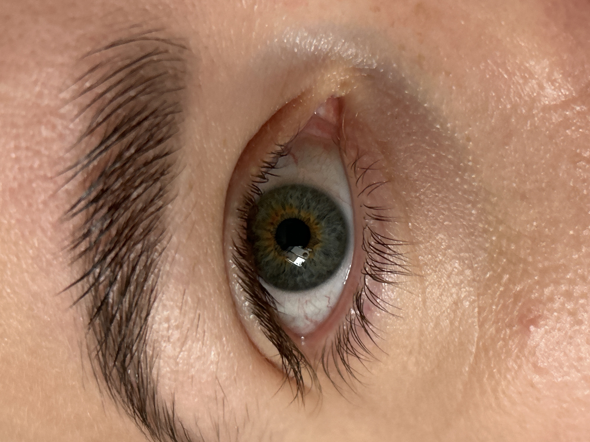 The media file displays an extreme close-up of a human eye, likely the right eye from the viewer's perspective, along with surrounding skin and eyebrow.
The central subject is the eye itself. The iris exhibits a captivating blend of green-blue tones, with a prominent golden-brown or amber ring directly encircling the black pupil, indicative of central heterochromia. A distinct reflection of two rectangular light sources is visible within the pupil, suggesting the presence of artificial lighting or a window. The sclera (white of the eye) shows fine red blood vessels, a common anatomical feature.
Dark, natural eyelashes frame both the upper and lower eyelids. Above the eye, a segment of the eyebrow is visible, composed of dark, well-defined hairs that appear natural and slightly unruly. The skin around the eye and on the forehead area reveals typical human skin texture, including pores and some subtle lines. One of the cropped images highlights a small, slightly raised blemish or bump on the upper eyelid/brow area.
The activity depicted is simply the eye being open and gazing steadily. No specific emotional expression is discernible. The lighting is soft, emphasizing the intricate details of the eye and skin. No text is visible anywhere in the image. Due to the extreme close-up nature, time of day, weather conditions, or any specific location cues are not apparent. The provided context of Chaikovsky, Russia, cannot be visually confirmed from the media content.