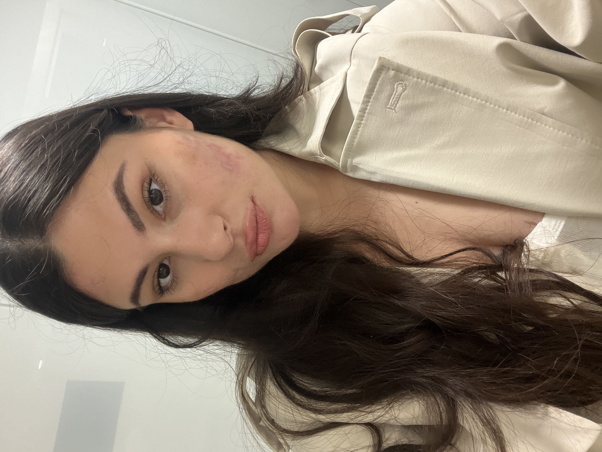 A person is looking at the camera with some redness on their right cheek. They have long dark hair and are wearing a light-colored jacket. The background appears to be a white wall. There is no information in the image to confirm that it was taken in Kiryat Bialik, Israel.