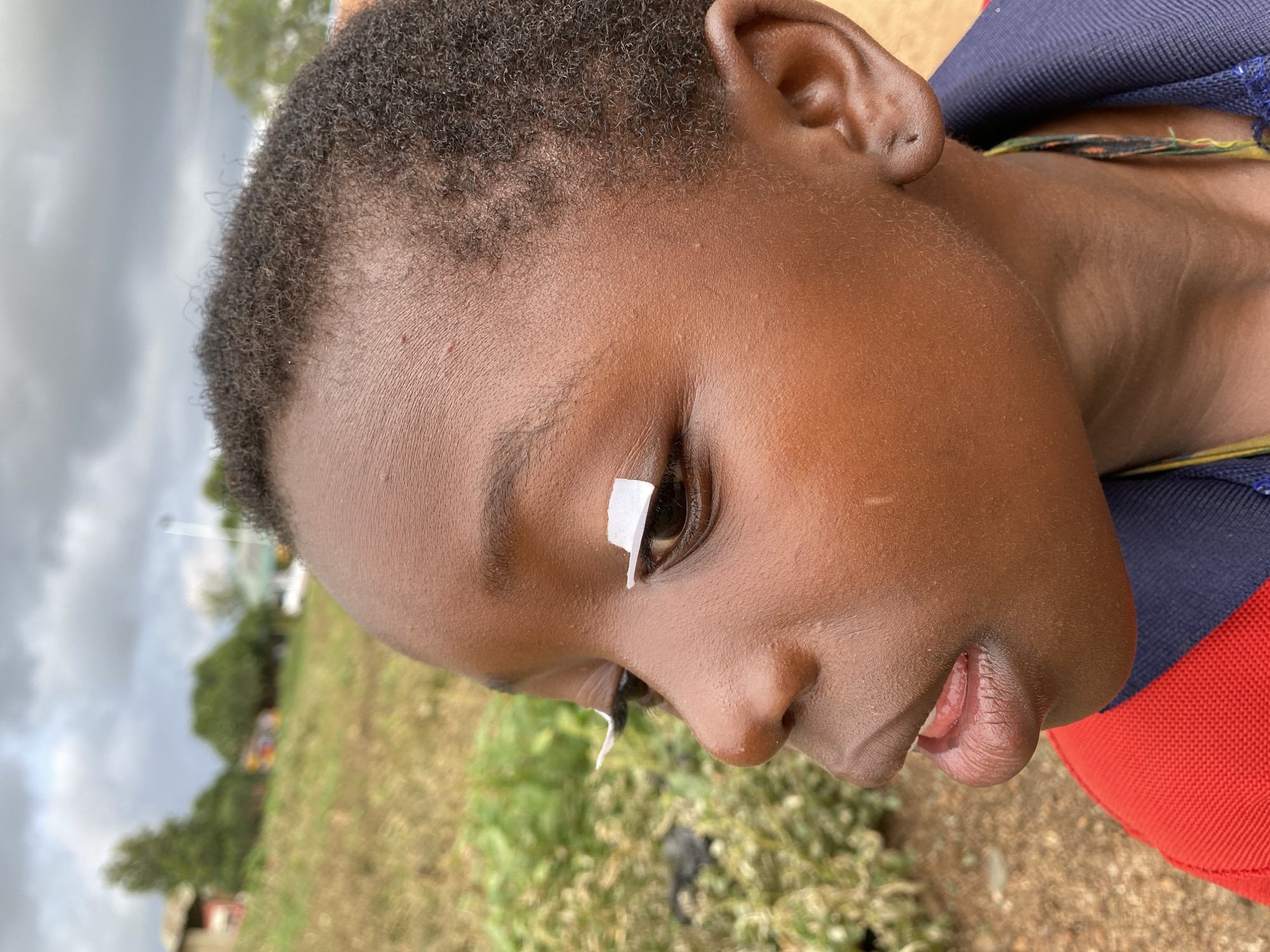 A close-up, outdoor shot of a child with dark skin and short, dark hair. A small, rectangular piece of white paper is taped above the child's right eye. The child is wearing a red and blue shirt. The background is slightly blurred, showing a grassy area and trees under a cloudy sky. The location is likely Vom, Nigeria, given the prompt.