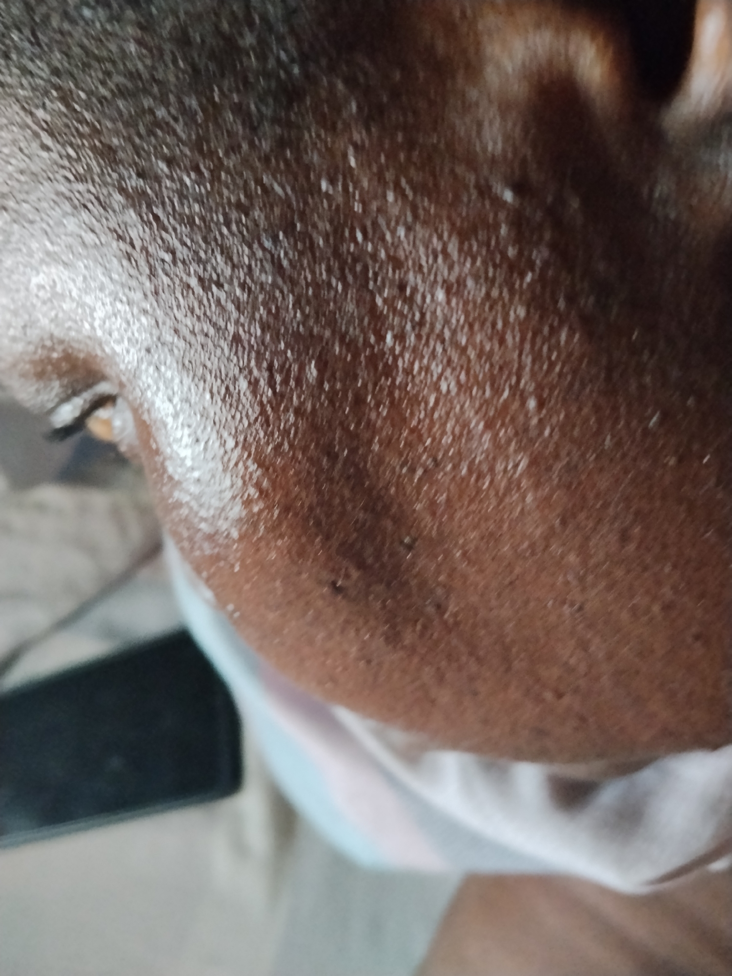 This close-up shot captures the left side of a person's head, focusing on their dark-toned skin and short, dark hair. The skin exhibits a visible sheen, suggesting the presence of sweat or oil, with discernible pores. A portion of the person's eye is visible on the left, showing a light brown iris and an open lid. Part of an ear can be seen towards the upper right.
Below the person's jawline, a white fabric with subtle light blue patterns is visible, possibly part of clothing or a face mask. In the lower-left corner, a black, rectangular object, likely a smartphone, is present but largely out of focus. The background is blurred, providing little detail about the immediate surroundings.
The image emphasizes the texture of the skin and hair. No specific activity is clearly depicted, but the visible perspiration on the skin suggests a warm environment or recent physical exertion. Given the location context of Shangisha, Nigeria, this is consistent with a hot and humid climate. No text is visible in the image.