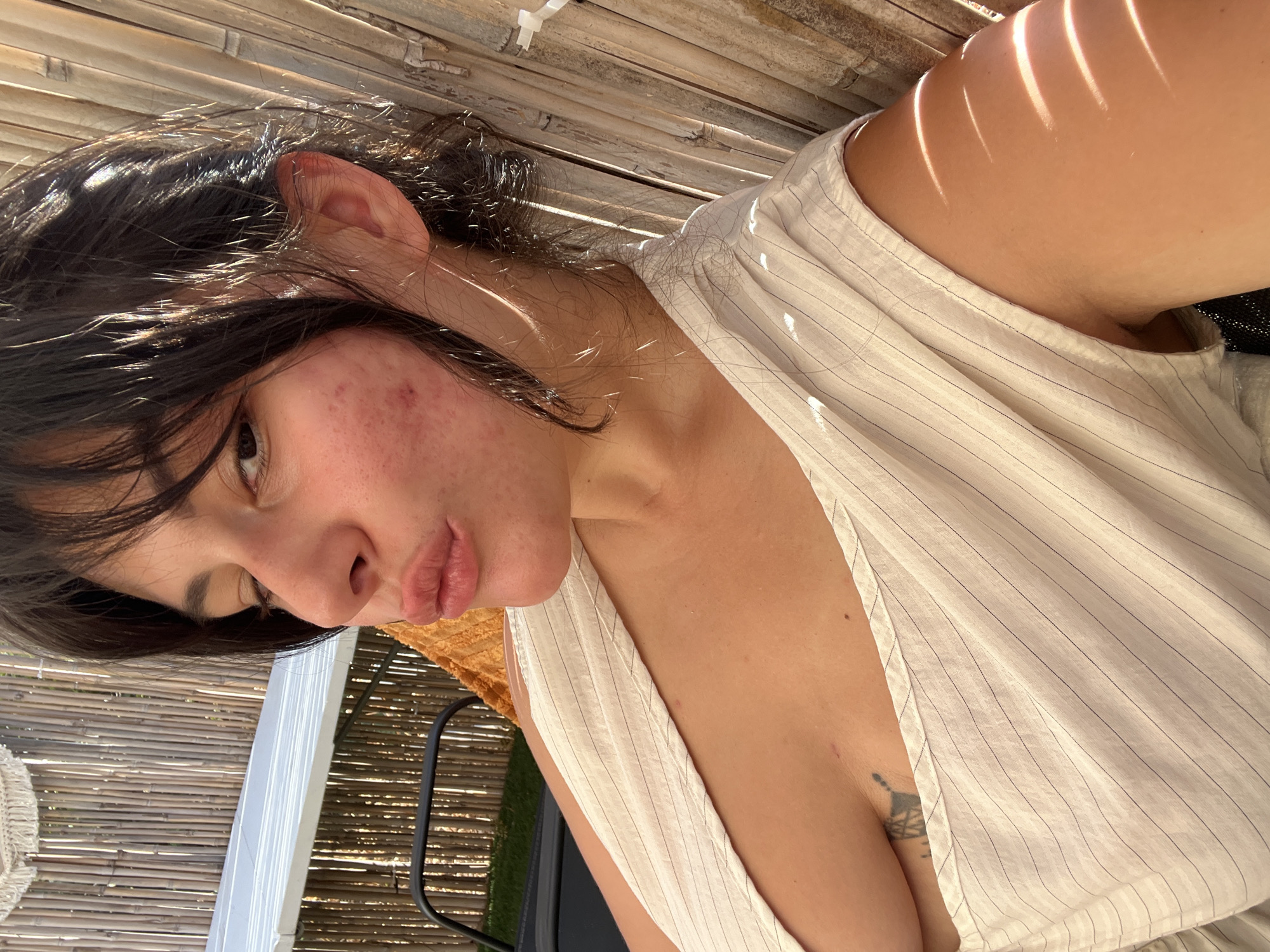 A woman is taking a selfie outdoors, possibly in Kiryat Yam, Israel. She is seated on a lounge chair and has her lips puckered, as if for a kiss. The woman has dark hair and light skin, with some redness and blemishes on her cheek. She is wearing a light-colored, sleeveless top with thin vertical stripes. A tattoo is visible on her chest. In the background, there is a bamboo fence and a white awning. The sun is shining, casting shadows on the woman's arm and the fabric of her shirt.