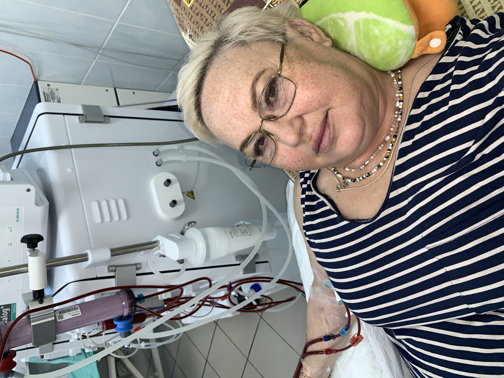 In the city of Chaikovsky, Russia, a close-up, eye-level shot captures a woman undergoing hemodialysis. She is lying down, with her head resting on a lime-green and orange pillow. Her face, adorned with numerous freckles and wearing glasses, is turned towards the camera. She has short, blonde hair. She is wearing a navy and white striped shirt. Medical tubing is visible connected to her arm. In the background, a large, white hemodialysis machine, labeled with "B. Braun", is prominently featured, with various tubes and filters attached. The environment appears to be a medical setting, possibly a hospital room, with tiled walls visible.