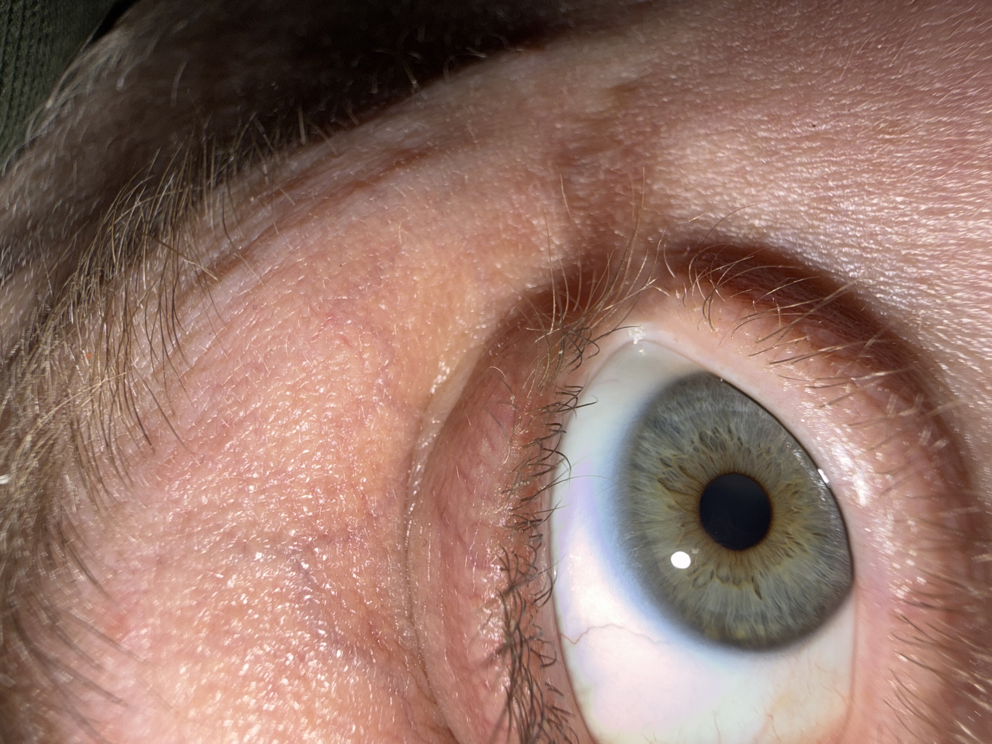 This is a close-up, macro photograph of a human eye, specifically focusing on the iris and surrounding skin. The iris is a striking blue-green color with intricate radial patterns and a dark pupil. The sclera, or white part of the eye, is visible and appears slightly reddened in some areas, suggesting it is bloodshot. Eyelashes frame the lower lid, appearing sparse and light brown. The skin surrounding the eye is fair-complexioned with visible pores and fine wrinkles, indicating an adult. The lighting creates subtle shadows and highlights on the skin's texture. There are no discernible objects or activities that would place this image in a specific urban environment like Moscow, Russia. The image's content is solely focused on the biological features of the eye and skin.