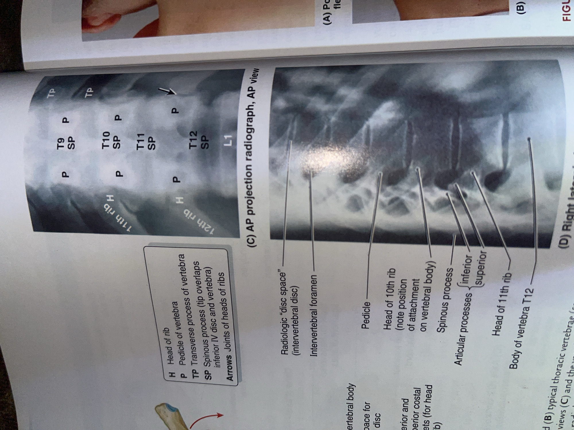 The image displays two medical X-rays of the thoracic and lumbar spine, likely from a textbook or educational material.
The left side of the image shows a diagram labeling parts of a rib and vertebrae, with a key indicating "H" for Head of rib, "P" for Pedicle of vertebra, "TP" for Transverse process of vertebra, and "SP" for Spinous process. It also labels "Intervertebral foramen" and "Radiologic 'disc space'".
The right side of the image shows two X-ray views. The upper X-ray is an AP (anteroposterior) projection radiograph of the thoracic spine, with labels T9 through T12 and L1 indicating vertebral levels. Various parts of the vertebrae are also labeled with "P", "SP", and "TP". A black arrow points to the posterior aspect of T12.
The lower X-ray is a lateral view of the lumbar spine, showing intervertebral discs and vertebral bodies. Multiple lines from the left diagram extend to label structures on this X-ray, including the "Pedicle", "Head of 10th rib", "Spinous process", "Articular processes" (superior and inferior), "Head of 11th rib", and "Body of vertebra T12".
There is no information in the image that relates to the city of Jalingo, Nigeria.