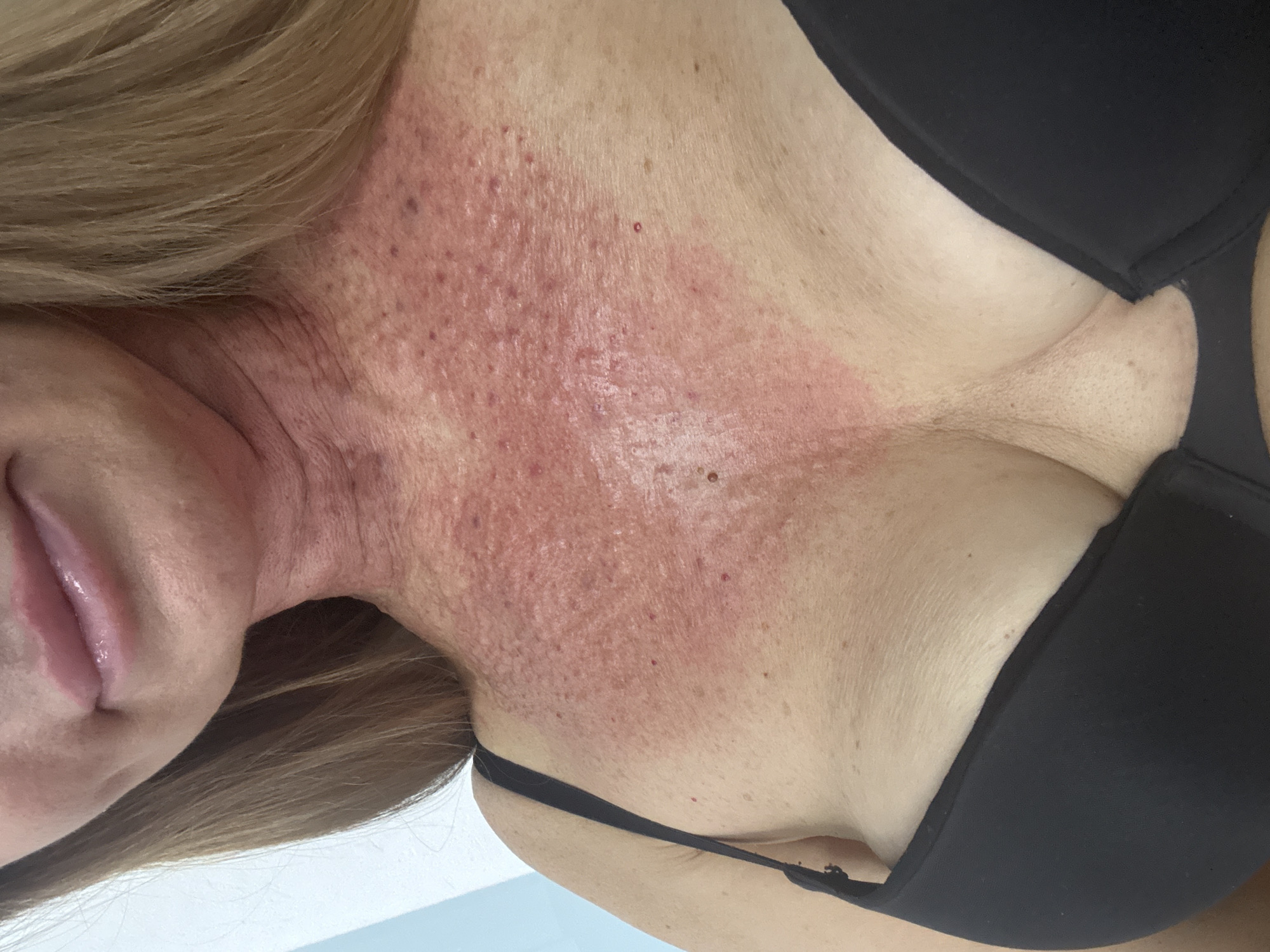 A close-up, indoor, medium-shot image shows the upper chest, neck, and chin of a light-skinned individual with blonde hair. The individual is wearing a black bra. The skin on the neck and upper chest is red and appears to have small bumps and some darker spots. The lips are pink and glossy. The background is a plain, light blue wall and a wall that is out of focus. No specific location in the city of Dnipro, Ukraine, can be determined from the image.