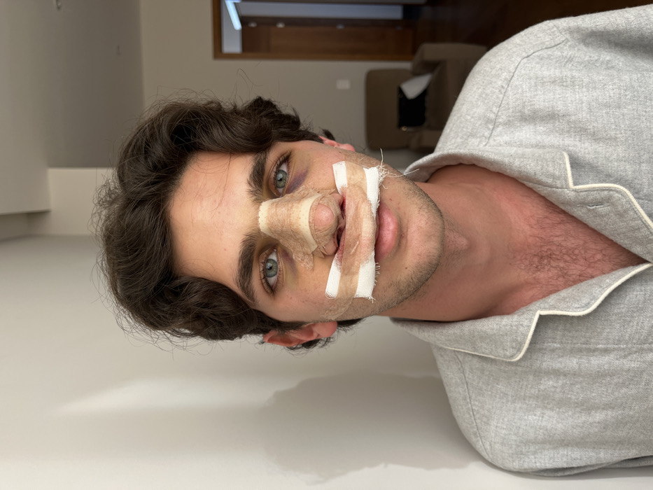 A young man lies on a white surface, his head turned towards the camera. He has dark, curly hair and blue eyes, with bruising visible under one eye. His nose is heavily bandaged. He is wearing a grey pajama shirt with a white trim. In the background, a door and a couch are visible, suggesting he is indoors. The image is tilted at an angle.