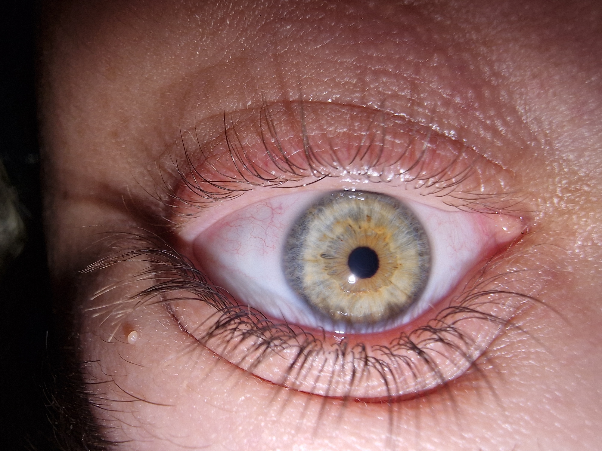 This image is a close-up of a human eye, likely female. The iris is a mix of grey, blue and yellow. The eye whites are slightly bloodshot. Dark eyelashes are visible on both the upper and lower lids. The skin tone appears fair, with fine lines noticeable around the eye. There is a small white bump on the skin below the lower lashes, possibly a milium. The lighting is slightly uneven, with some areas appearing darker than others. The location is unknown.