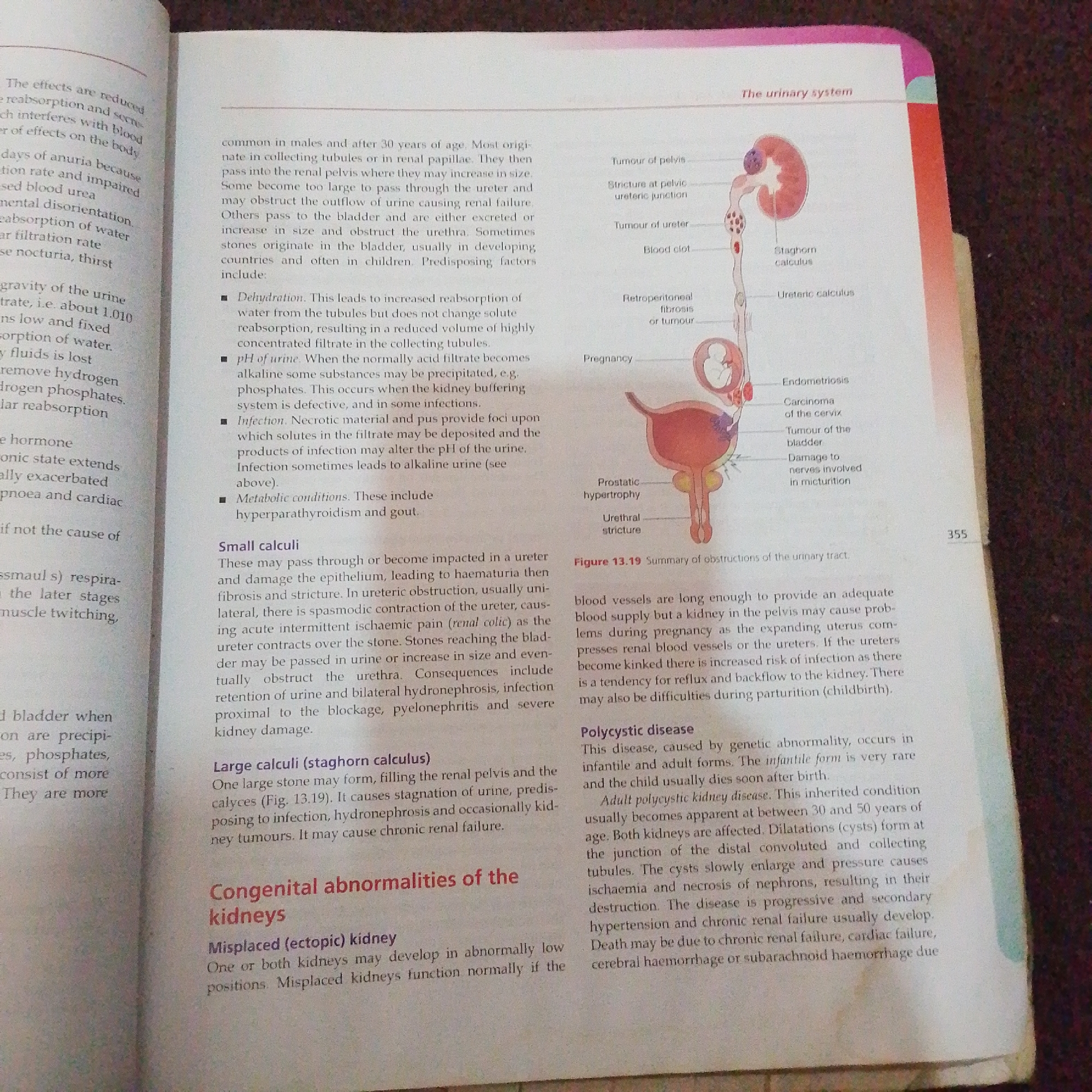 The image displays a page from a medical textbook discussing the urinary system and its potential problems. The content is divided into several sections, including "Small calculi," "Large calculi (staghorn calculus)," and "Congenital abnormalities of the kidneys." There is also a diagram illustrating various obstructions of the urinary tract, labeled "Figure 13.19 Summary of obstructions of the urinary tract." The text describes conditions such as kidney stones, infections, and genetic abnormalities like polycystic kidney disease. The page is part of a larger book, as indicated by the page number "355" at the bottom right. The image does not depict anything related to Jalingo, Nigeria.