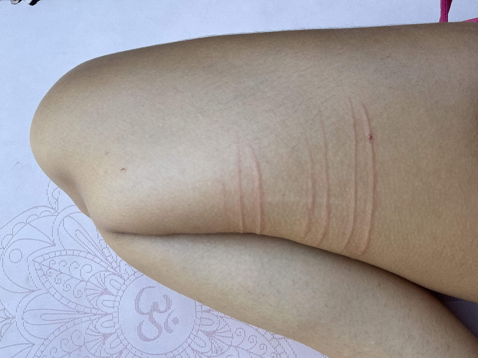 A close-up photograph depicts a bent, bare human leg resting on a patterned white surface. The leg displays linear marks or impressions, possibly skin indentations. A small reddish mark is visible on the upper part of the leg. The surrounding environment and location in Buduk, Indonesia are not discernible from the image.