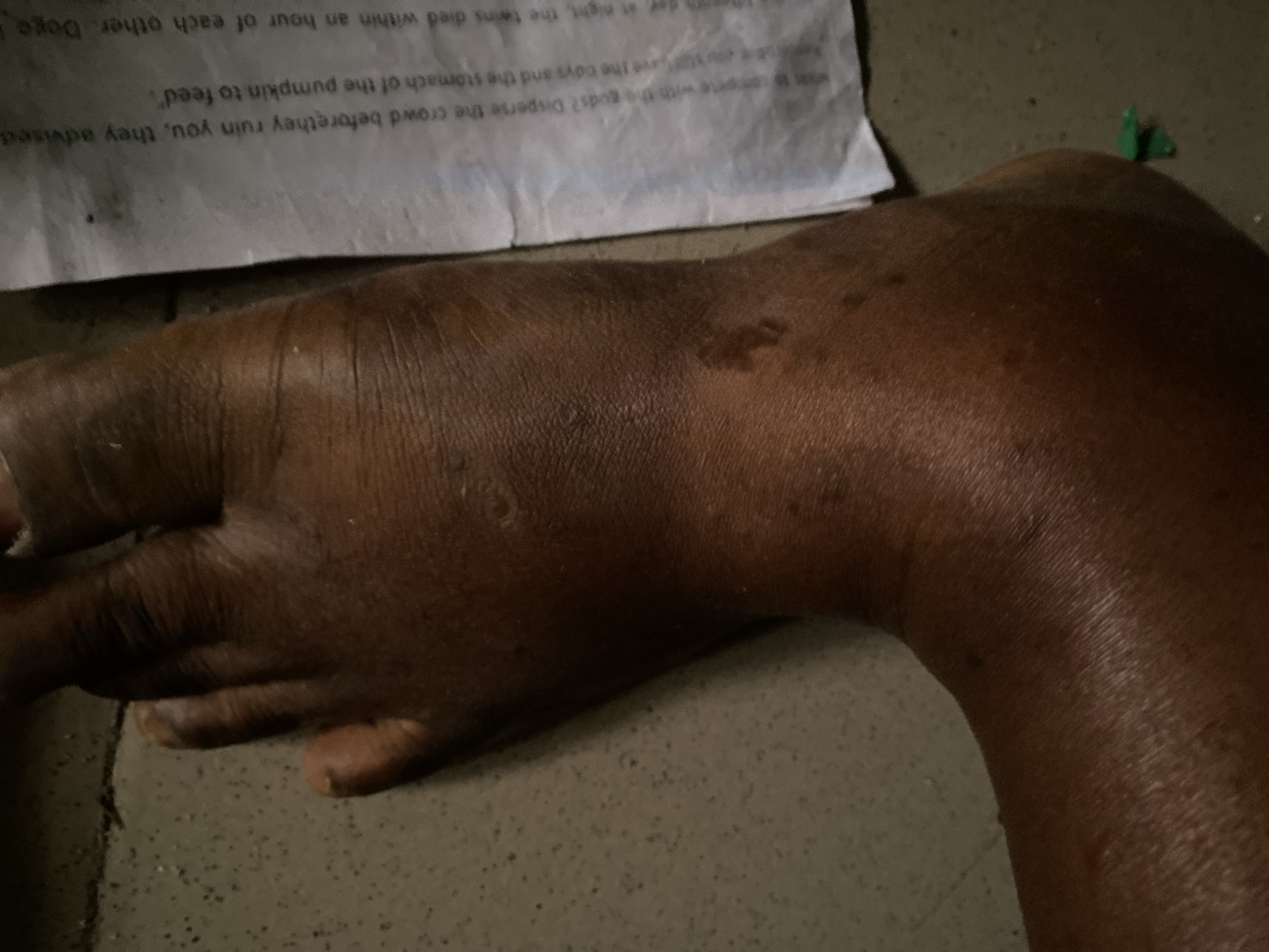 The image shows a close-up of a swollen, dark-skinned foot resting on a speckled, concrete-like surface. A crumpled piece of paper with text is visible to the right of the foot. The text is in English and appears to be a narrative passage. The environment suggests an outdoor setting, possibly in a rural or informal urban area, consistent with Jauro Yinu, Nigeria. There are no individuals clearly depicted in the image beyond the foot itself. The scene is static, with no apparent actions or interactions taking place.