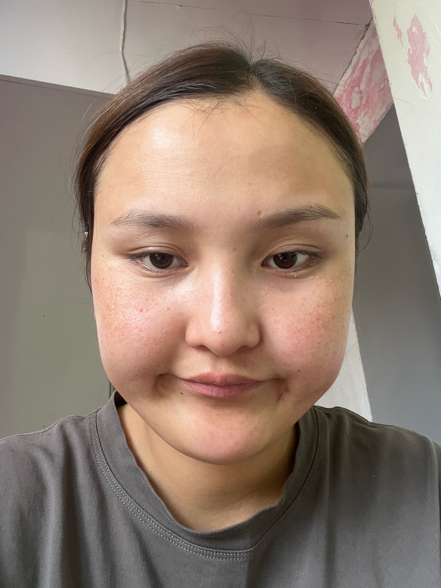 A young woman with dark hair pulled back and a grey t-shirt is shown from the chest up, facing the camera. Her face is slightly swollen, particularly her cheeks, and she has light skin with some freckles and redness around her nose and cheeks. Her eyebrows are dark and well-defined, and her eyes are dark brown. Her lips are slightly parted, with a hint of a smile. The background is out of focus, showing a grey wall and a white structure with peeling pink paint. There are no other people or objects visible in the frame. The scene appears to be indoors. There is no information that allows for localization to Dzhida, Kyrgyzstan.