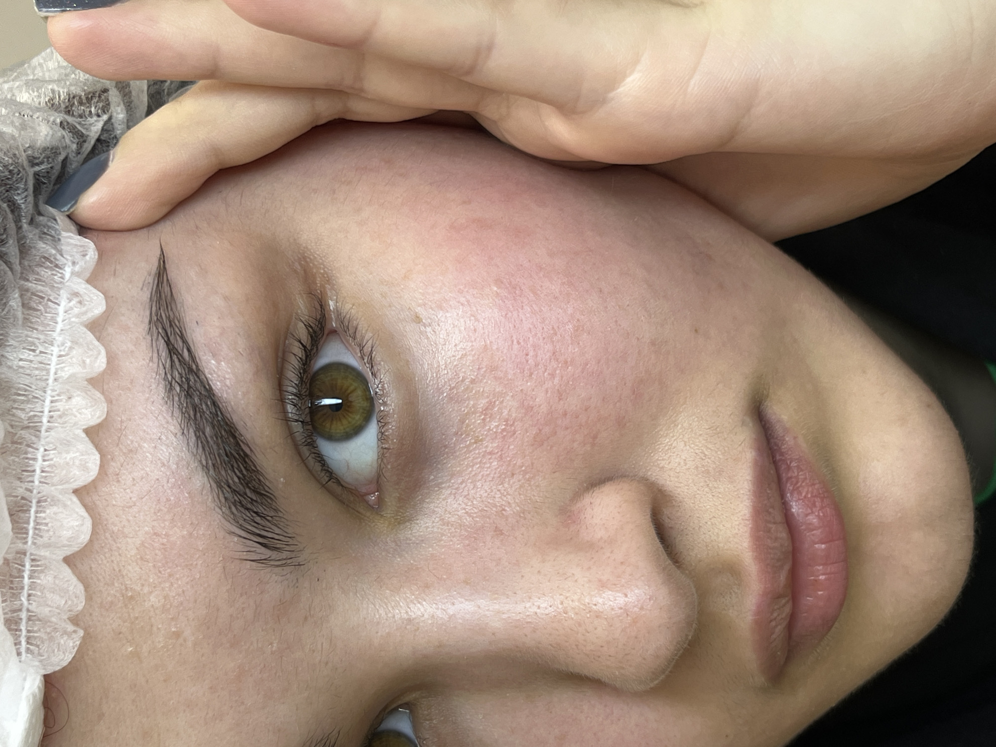 A close-up, angled shot shows the face of a person, likely female, with a hand partially obscuring the forehead. The person has brown eyes, dark eyebrows, and fair skin. The texture of the skin is visible, showing pores and slight redness. The lips are pink and full. The person is wearing a hairnet or cap, suggesting a clinical or cosmetic setting. The background is out of focus and appears to be a dark, solid color. The image does not provide information regarding the location or the city of Neftekamsk, Russia.