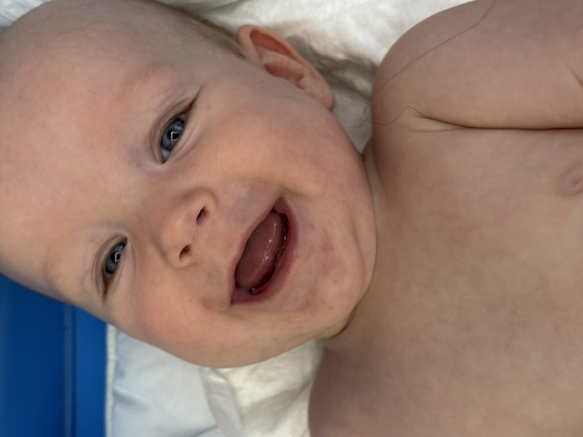 The image is a close-up, overhead shot of a baby's face and upper body. The baby has fair skin, blue eyes, and a wide, open-mouthed smile. Reddish splotches are visible on the baby's cheeks and around the mouth. The baby is lying on a white, textured surface, possibly a blanket or sheet, and a portion of a blue surface is visible in the upper left corner. The background is out of focus. The image appears to be taken indoors. There is no information to suggest this image is located in Moscow, Russia.