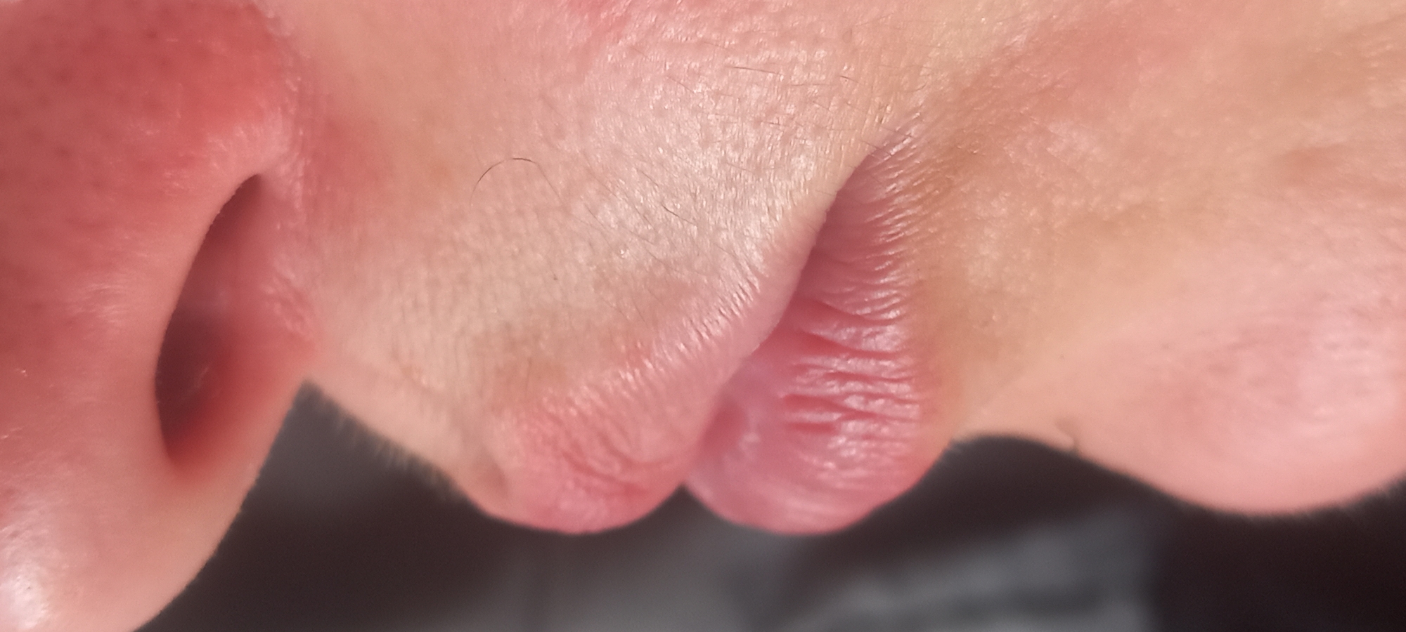 The location is in the city of Kryvyi Rih, Ukraine. The image presents a close-up, profile view of a human face, specifically focusing on the nose, upper lip, and a segment of the chin. The subject's skin is light-toned, exhibiting a pinkish-beige hue with localized redness, particularly around the right nostril and the philtrum area above the upper lip. Fine vellus hairs are discernible across the skin surface, and a single, darker, curved hair is prominent on the upper lip region. The lips are slightly parted, revealing both upper and lower lip surfaces with distinct vertical striations, suggesting a natural texture or mild dehydration. The background is uniformly dark and out of focus, providing no contextual details beyond the immediate subject. No other subjects or objects are present.