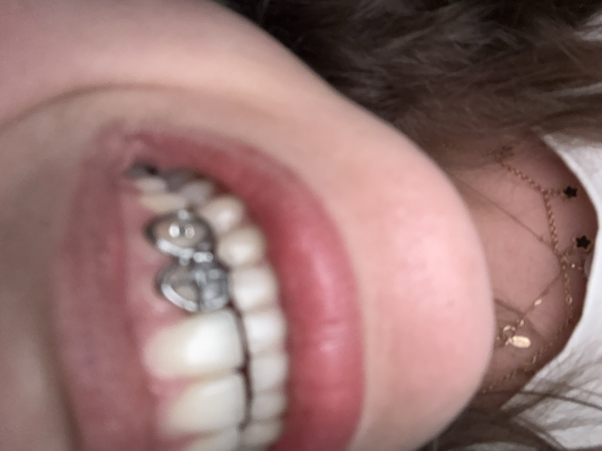 The image shows a close-up of a person's mouth with teeth. The person has braces on their teeth. A silver-colored orthodontic appliance is visible. The surrounding skin and lips are also in focus. In the background, a gold-colored necklace is visible on the person's skin. The image is too blurred to identify the precise city location in Sofia, Bulgaria.