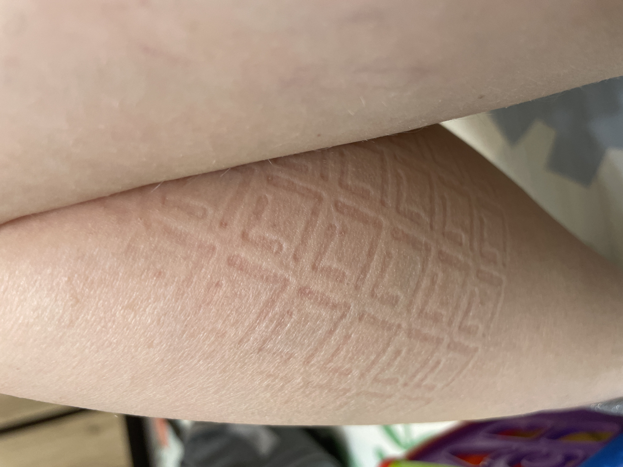 An arm has been indented with a patterned grid that is raised as wheals on the skin.
There is no information visible in this image that relates to the city of Chaikovsky, Russia.