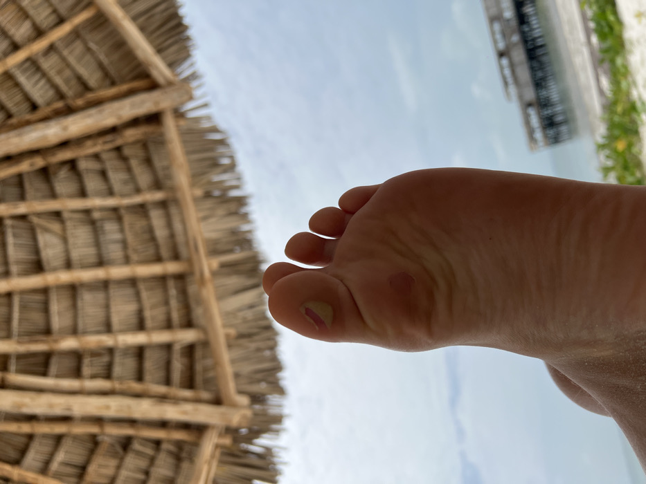 The image displays a close-up, upward-angled view of the sole of a human left foot, positioned centrally in the foreground. The foot exhibits a yellowish-pink blister on the ball of the big toe and a distinct reddish circular mark on the central sole below the toes. Above the foot, the underside of a circular thatched roof structure, composed of natural woven materials and supported by wooden beams, occupies the upper third of the frame. Beyond the foot and the thatched structure, a cloudy sky is visible. In the distant background, a blurred coastal environment is present, featuring calm ocean water, a strip of sandy beach with sparse green foliage, and a wooden pier extending into the water. This scene is situated on a beach in Zanzibar, Tanzania.