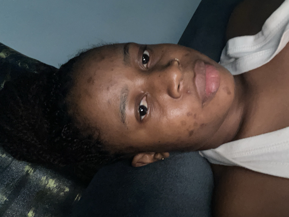A woman with dark skin and dark, curly hair lies on a dark gray surface. She wears a white top. Her face features brown eyes, a nose ring, and light pink lips. Uneven pigmentation is visible on her forehead, cheeks, and around her mouth. The background consists of a dark green and black patterned material on the left and a blue wall above.