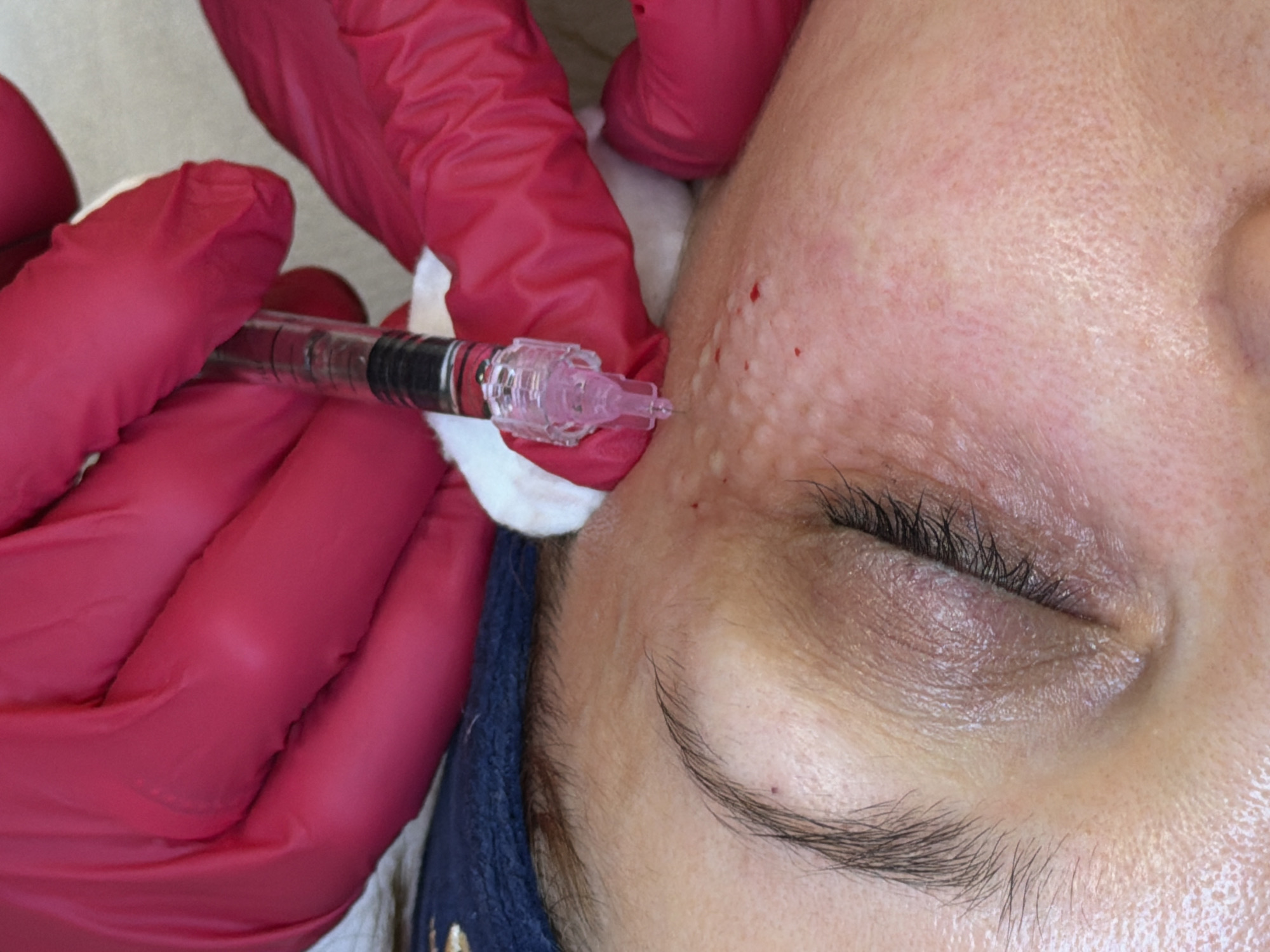 A close-up shot depicts a cosmetic procedure in progress on a person's face. A person wearing red gloves is injecting a substance into the forehead of a patient. The needle is visibly piercing the skin, and small raised bumps are visible on the forehead, indicating previous injection sites. A cotton pad is being used to clean the injection area. The patient has their eyes closed and appears to be lying down, with a blue headband visible. The background is blurred, focusing attention on the procedure. The photograph does not contain the information for the location in the city of Sofia, Bulgaria.