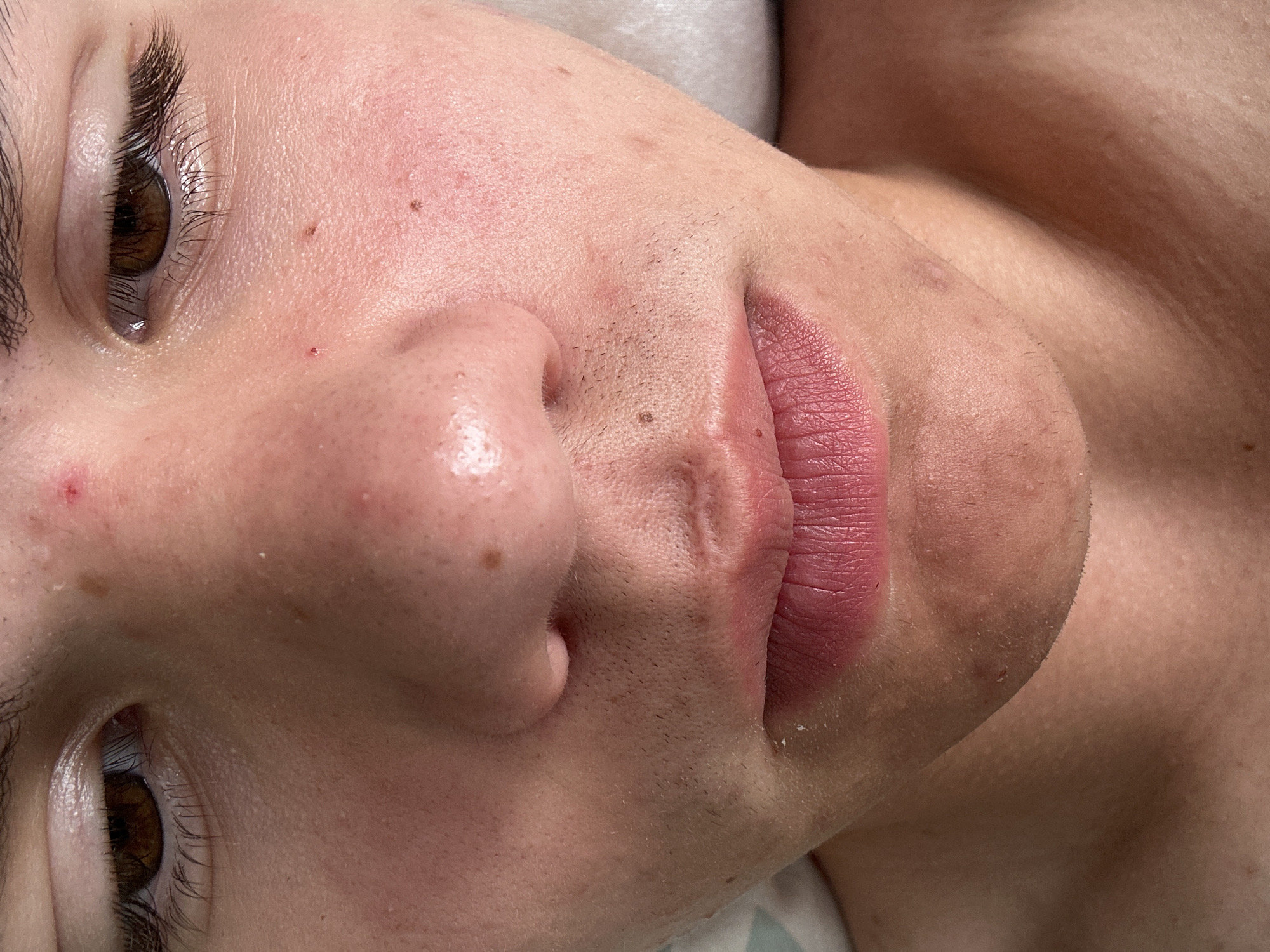 A close-up, medium shot photograph shows the lower half of a person's face, from the eyebrows to the upper chest. The person has fair skin with visible pores, some blemishes, and a few small hairs on the upper lip and chin area. The eyes are brown with dark eyelashes. A small red pimple is visible on the forehead above the bridge of the nose, and another on the cheekbone. The lips are full and colored with a pinkish hue. The background is a blurred white surface, possibly a pillow or bedding. The image is well-lit, with natural light illuminating the face from the front and slightly to the side. The focus is sharp on the facial features, with the background softly blurred. The overall impression is that of a candid, unposed photograph. The location is Unknown, Unknown.