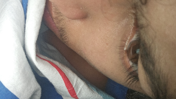 A close-up, angled view shows a person's face partially covered by a white towel with blue and red stripes. The focus is on the nose, cheek, and eye area. The skin appears to be light brown, and fine hairs are visible. The eye is partially open, revealing a dark iris. The white towel is crumpled and close to the face. A dark shape casts a shadow across the neck and the lower portion of the face.