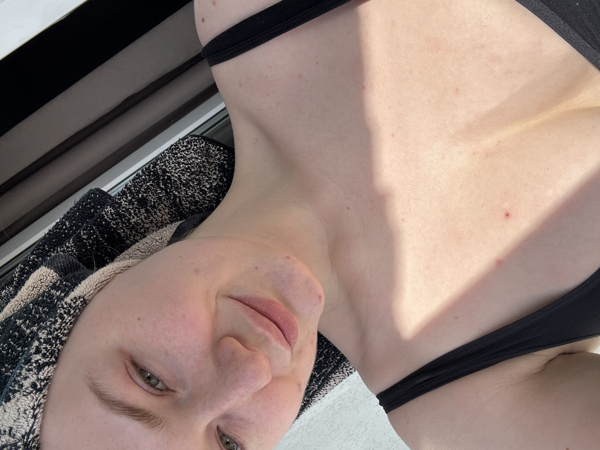 The image displays a female individual, captured from approximately the upper chest upwards, illuminated by bright natural light. Her head is wrapped in a black and beige/white patterned towel, securing her hair. She has fair skin, green eyes, and light-colored eyebrows, with a subtle smile directed towards the camera. Multiple small, red blemishes are visible on her face, neck, and upper chest. She is dressed in a black strap top or undergarment. A defined shadow, consistent with direct sunlight, falls diagonally across her chest. The background consists of a plain light-colored wall or surface to the left and dark vertical blinds or curtains behind a window frame to the upper right. The specific location within the city of Kazan, Russia, cannot be determined from the visual information present in the image.