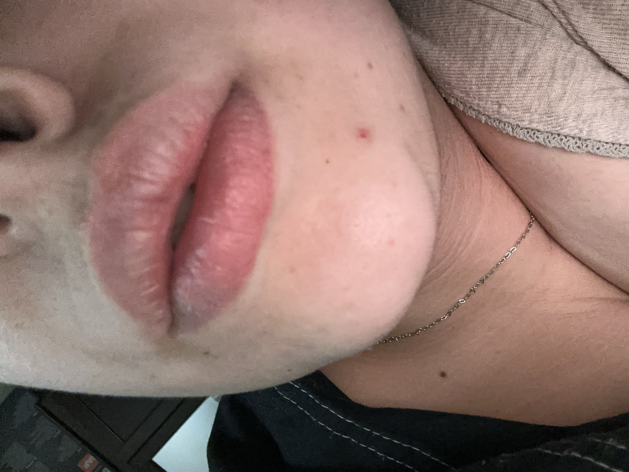 Close-up image of a person's face focusing on the lips, nose, chin, and neck. The lips are full and pink. A red blemish is visible on the cheek near the lips. A silver chain necklace is visible around the neck. The person is wearing a beige shirt or sweater at the top and a black shirt at the bottom. The image is taken indoors. Location and time is not discernible.