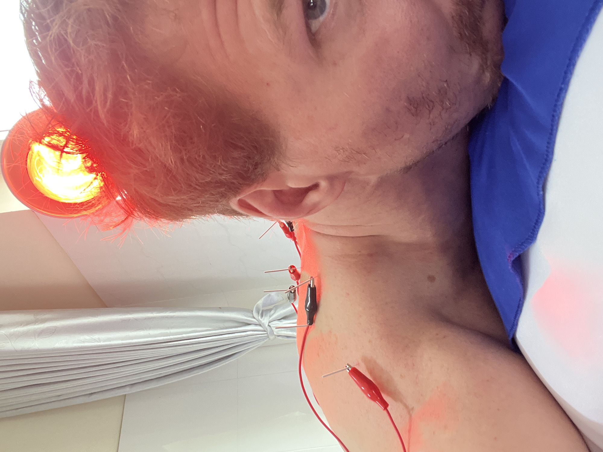 The image shows a man undergoing what appears to be electroacupuncture treatment. Needles are inserted into his neck and upper chest, connected to wires with alligator clips. A heat lamp shines on his head and neck. The location is likely a medical office in Nam Nha Trang Ward, Vietnam, indicated by the title. The room appears to be clean and sterile, with white tiled walls and a curtain in the background. The man is wearing a blue and white top.