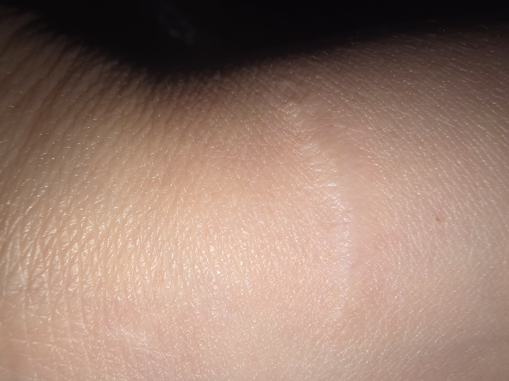 The image displays a close-up view of human skin, showing natural textures and creases. A faint, lighter-colored scar is visible across the central portion of the frame. The lighting creates a shadow on the right side of the image, obscuring part of the skin. The image does not contain any information related to the city of Ulan-Ude, Russia, or any specific location.