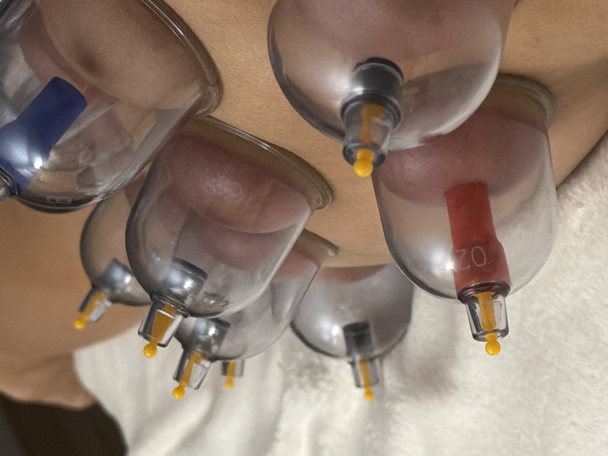 The image shows multiple cupping therapy cups adhered to a person's back. The cups are transparent with colored plungers, some red, some blue, and some yellow. The skin is raised within the cups. A white, textured surface is visible in the background. There are no indications to identify the location of this scene within the city of Saint Petersburg, Russia.