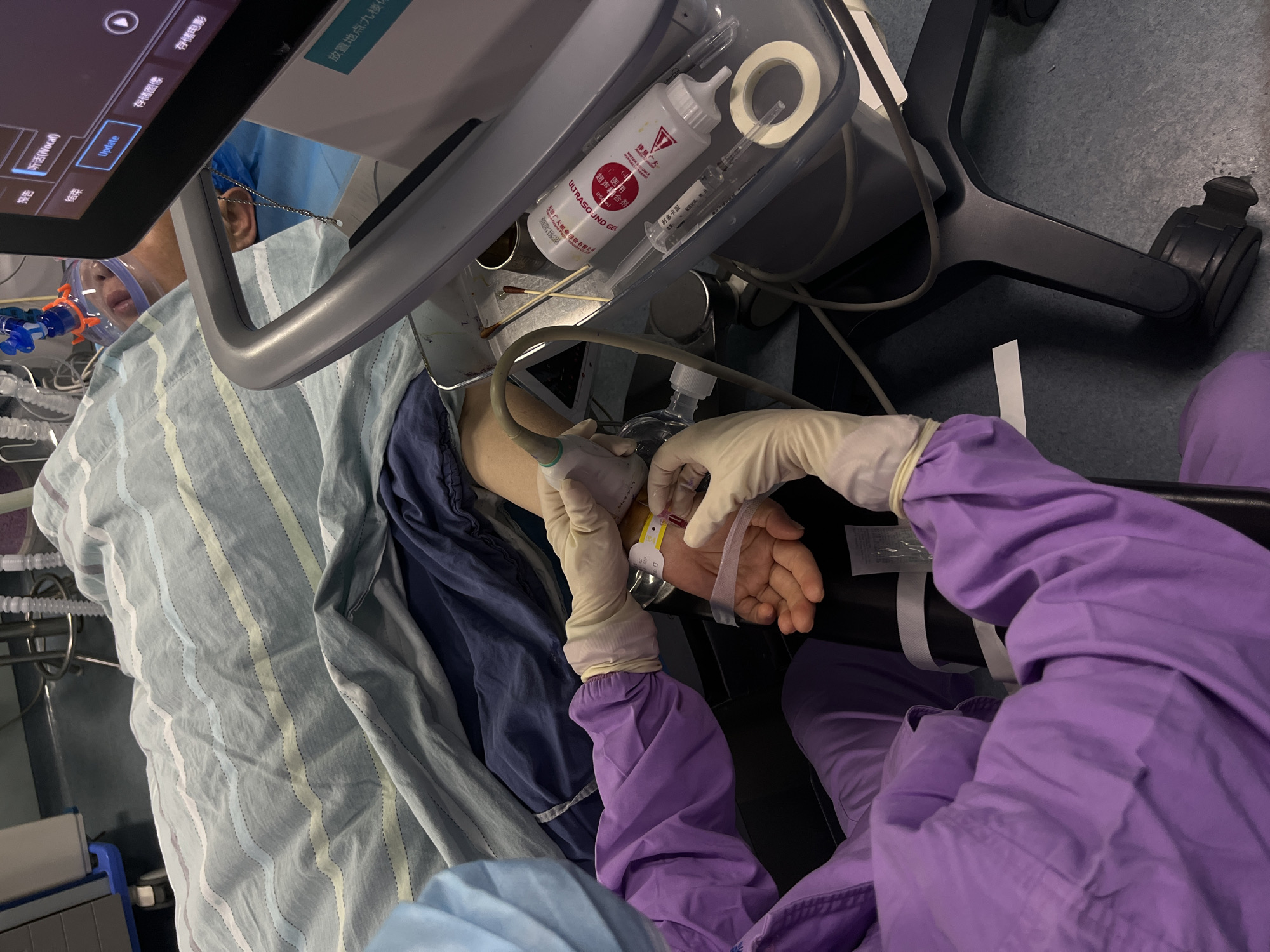 In a medical setting, likely a hospital or clinic in Yuzhong District, China, a patient is undergoing a medical procedure involving an ultrasound. The patient is lying on a bed, covered by a light blue and white striped sheet, with an oxygen mask covering their nose and mouth. Their right arm is extended, positioned for the procedure.
An unseen medical professional, wearing purple scrubs and beige medical gloves, is performing an ultrasound on the patient's forearm. One hand holds the ultrasound probe firmly against the skin, while the other hand is near the patient's wrist, where a yellow and white wristband is visible. The patient's forearm also has what appears to be a clear dressing or monitoring patch.
To the left of the scene, part of an ultrasound machine is visible, featuring a digital screen displaying options in Chinese, including "存储图像" (store image), "存储电影" (store movie), "Update", "报告" (report), and "结束" (end). Another label on the machine reads "放置地点:九楼" (Location: 9th Floor). Adjacent to the screen, a clear tray attached to the machine holds medical supplies: a white squeeze bottle labeled "医用" (Medical use), "超声耦合剂" (Ultrasound coupling agent), and "ULTRASOUND GEL"; a syringe clearly marked "利多卡因" (Lidocaine); and a roll of white medical tape. The base of the machine, equipped with wheels, is also partly visible on the grey floor. The lighting suggests an indoor, well-lit environment.