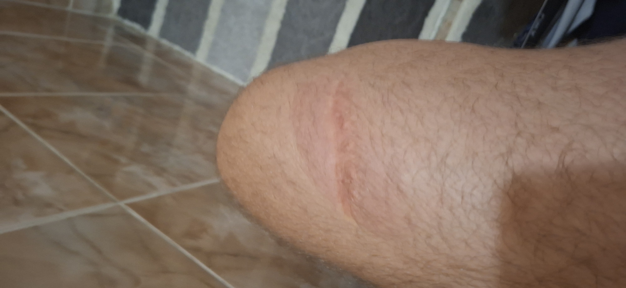 The image shows a close-up view of a person's knee. The knee has a prominent, reddish scar running horizontally across it. The surrounding skin is covered in fine, light-colored hair. The background appears to be a tiled wall and a striped floor, suggesting an indoor environment such as a bathroom or shower. The location in Almaty, Kazakhstan, is not ascertainable from the visual information provided.
