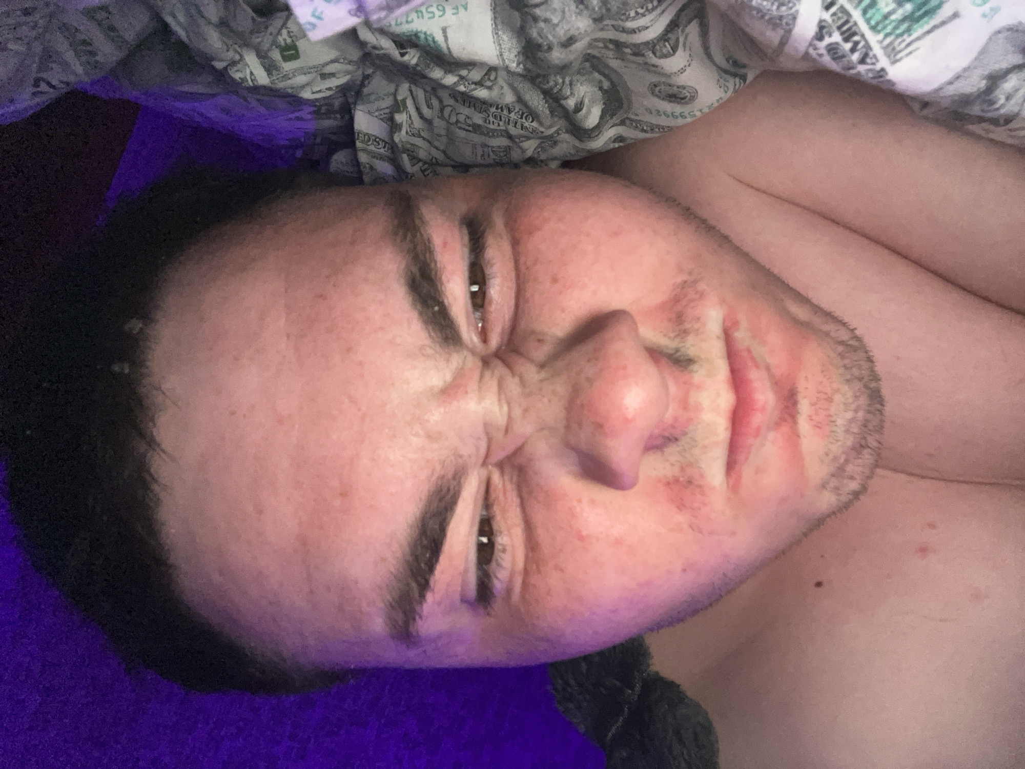 The image displays a close-up, distorted view of a person lying down, with their head tilted. The person appears to be male, with fair skin showing some redness, particularly on the cheeks and around the nose. They have dark eyebrows and brown eyes, which are partially closed and squinted. The lighting in the image is unusual, with a prominent purple hue cast over the top right portion of the frame, suggesting an artificial light source. The person is resting on fabric that appears to be a pattern of US dollar bills. The background is dark and out of focus. There is no discernible urban environment or any specific indication of the location being Zarudyntsi, Ukraine.