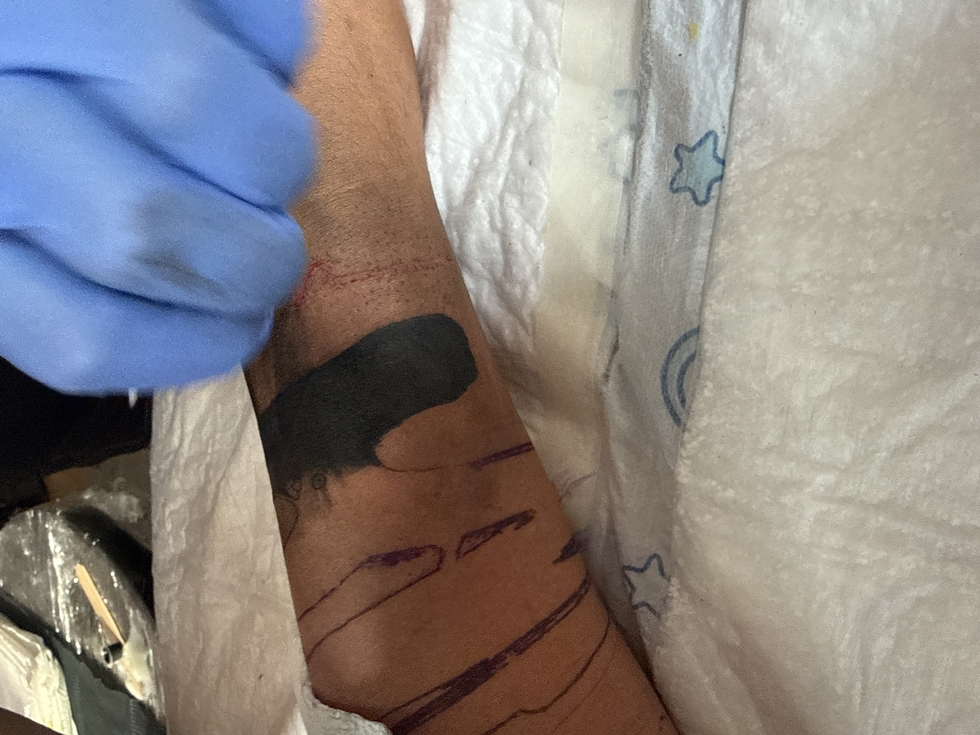The image shows a close-up view of a person's arm, likely undergoing a tattoo session. The arm is positioned on a white, textured surface, possibly a towel or paper sheeting, which is adorned with faint blue star patterns. A gloved hand, covered in a bright blue nitrile glove, is visible in the upper right corner of the frame, holding a tattoo needle and seemingly applying ink to the skin.
The arm itself displays a freshly tattooed area of solid black ink. Surrounding this area, purple lines are drawn on the skin, indicating a stencil or design outline for future work. There are also areas of redness and what appears to be dried blood on the skin, consistent with the tattooing process. The skin tone is medium.
The background shows a blurred view of a workspace, including what looks like a small black container (possibly an ink cap) and a wooden stick. The overall environment suggests a tattoo studio or a similar artistic setup. There is no indication of the specific location within Budva, Montenegro, as the image focuses solely on the immediate task at hand.