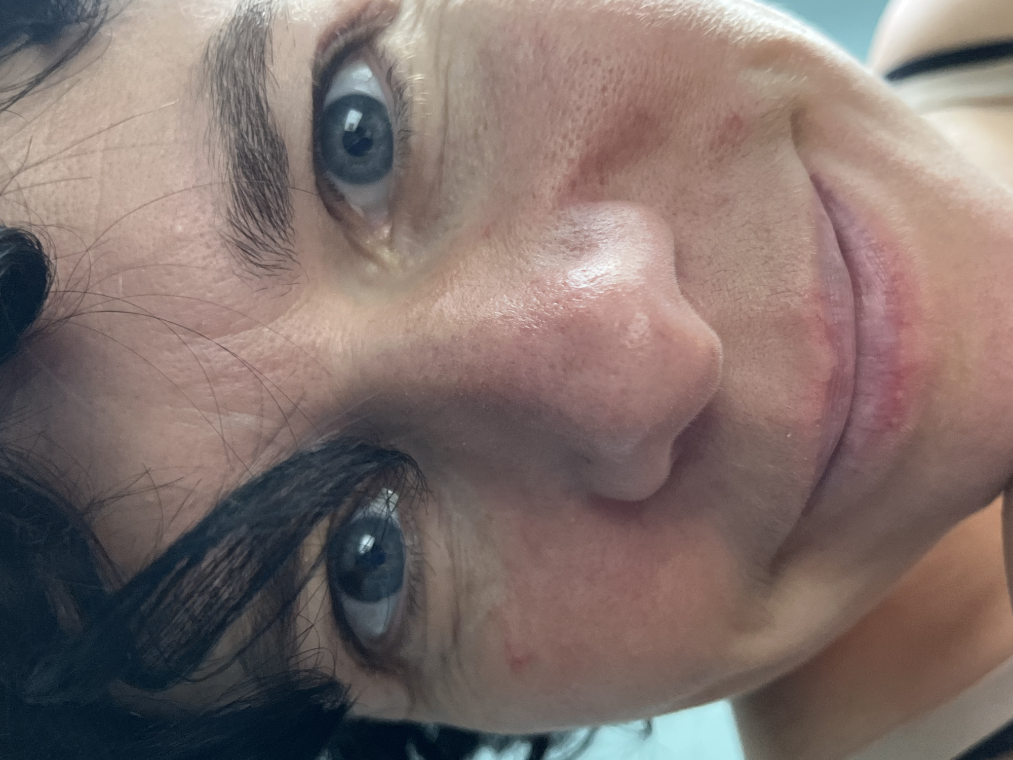 A close-up, frontal, eye-level shot focuses on the face of a woman with dark hair. Her hair partially obscures her left eye and forehead. Her skin is light-toned with some redness on her cheeks and around her nose. Her eyes are open and appear blue. She is smiling slightly, revealing her lips. The background is out of focus and a solid light blue color. The image is a selfie taken in a domestic setting, likely in a home. No specific location in ღრმაღელის თემი, Georgia can be identified from the image alone.