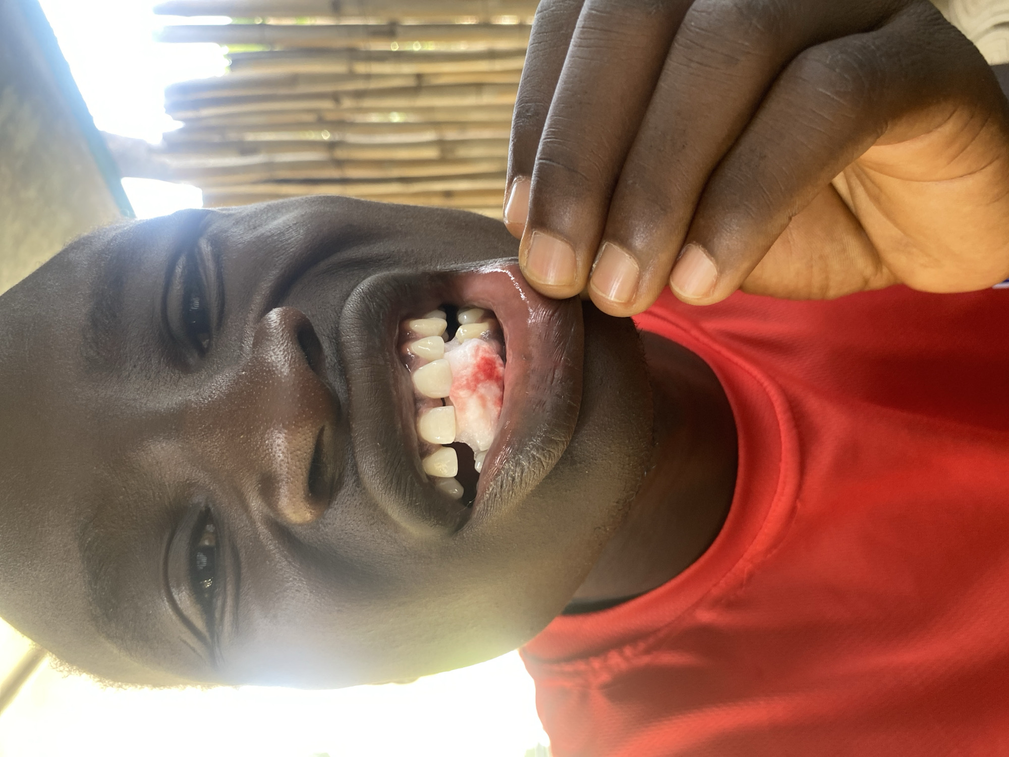 A dark-skinned person in a red shirt is showing their teeth. There is a wad of bloody cotton in their upper gums. One hand is pulling the upper lip up and back. The background is out of focus but appears to be a thatched or bamboo structure. The photograph appears to be taken outside with bright sunlight. The exact location in Barden Yana, Nigeria is indeterminable from the image.