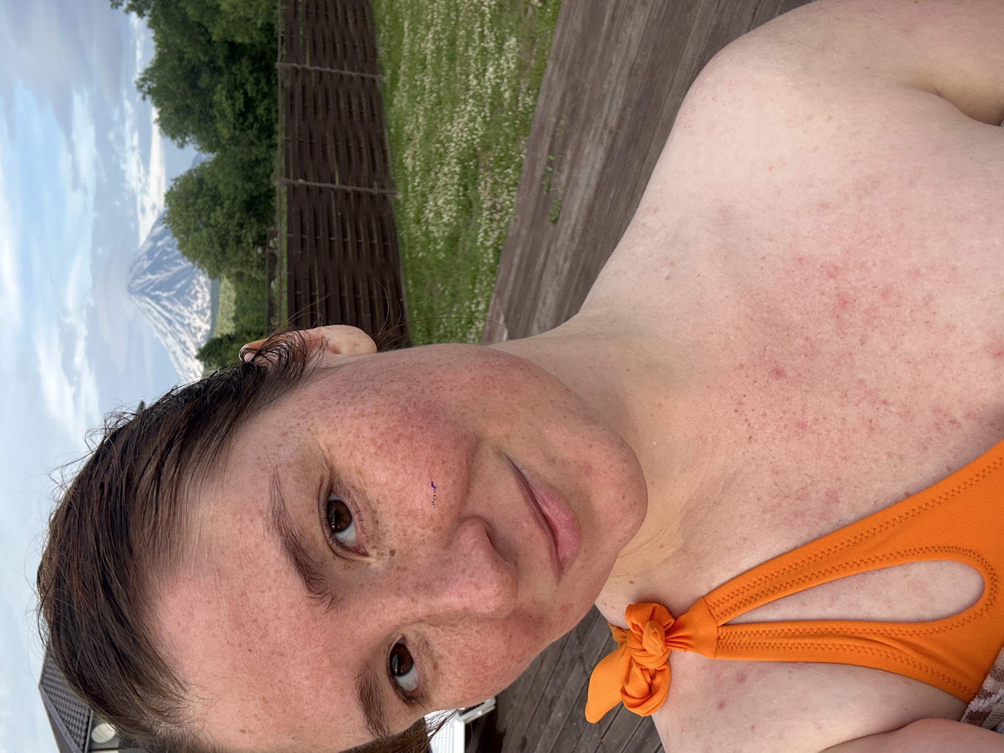A woman with fair skin and freckles is taking a selfie outdoors. She is wearing an orange bikini top. Her hair is dark brown and pulled back. Her skin appears red and slightly irritated. In the background, there is a wooden fence, green grass with white flowers, trees, and a snow-capped mountain under a cloudy sky. The scene appears to be in a rural or natural setting.