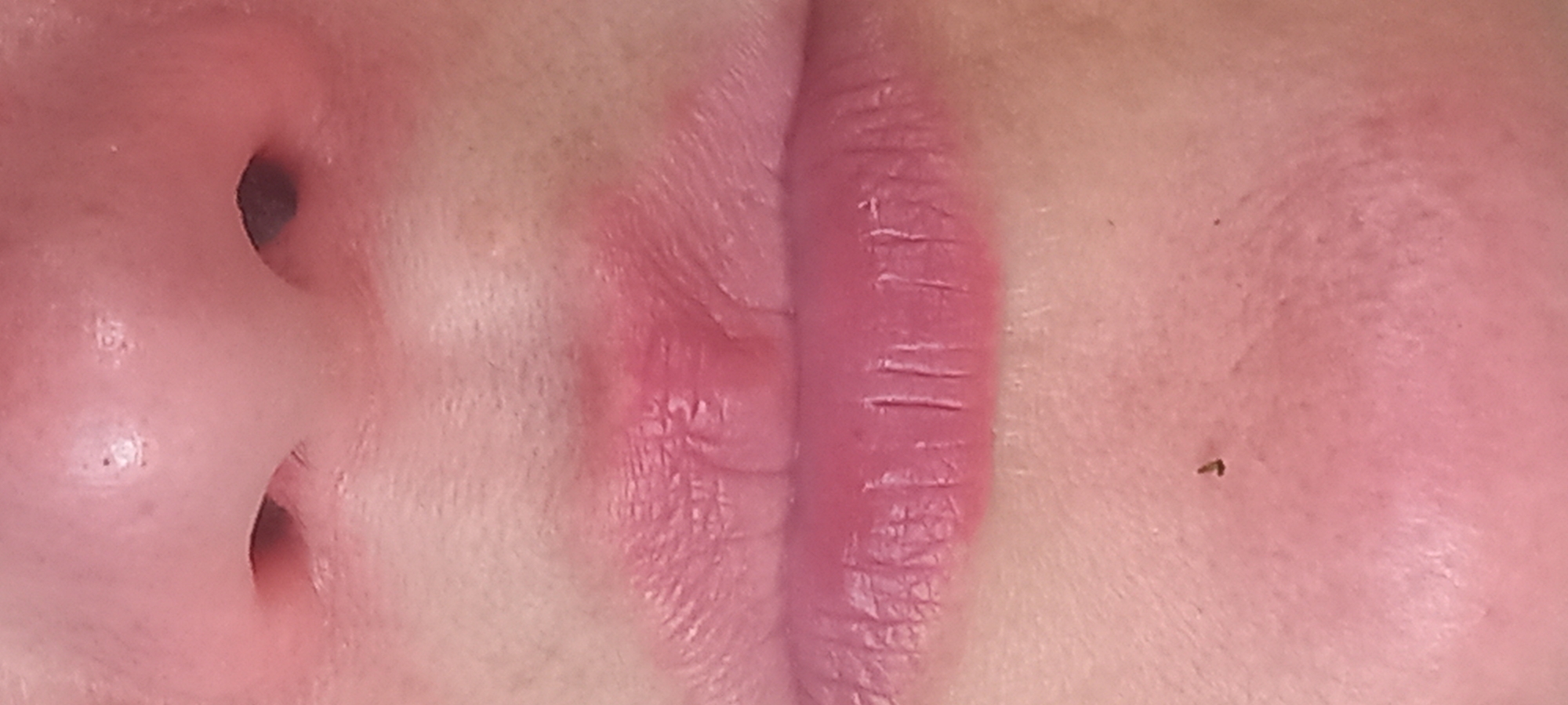 The image displays a close-up, frontal view of a human face, focusing on the area from the lower bridge of the nose to the chin, located in Kryvyi Rih, Ukraine. The subject exhibits fair skin with a reddish tone, particularly around the nose and upper lip.
The lower portion of the nose is visible, featuring two dark, open nasal apertures. The skin on the bridge and sides of the nose shows visible pores and a few small, dark specks.
Directly above the upper lip, within the philtrum, there is a prominent, raised, reddish lesion with an irregular, somewhat crusted texture, positioned centrally. The upper lip itself displays distinct vertical lines and appears slightly swollen around the central lesion.
The lower lip has a natural pink hue with visible vertical creases. Below the center of the lower lip, a tiny, dark, irregularly shaped object or mark is present on the skin. The surrounding skin of the chin area shows fine lines and typical skin texture. No other objects or specific environmental details are discernible.