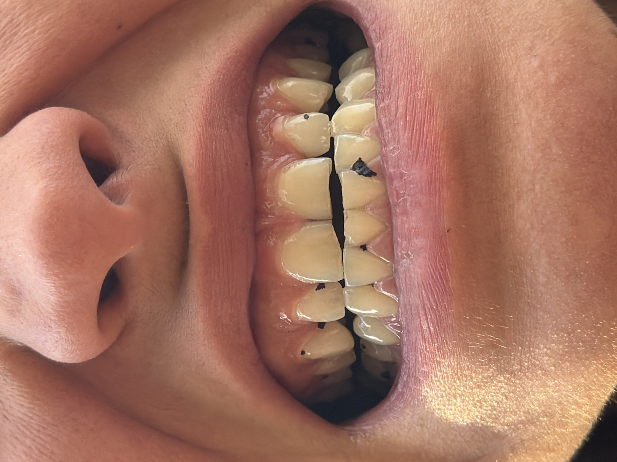 A close-up, upward-angle view depicts the interior of a person's mouth. The image primarily focuses on the teeth, which are off-white in color and appear to have black particles or stains on their surfaces. The gums are visible, with the surrounding skin of the lips and cheeks displaying varying shades of pink and red. The texture of the skin is also noticeable, indicating pores and minor skin imperfections. The left side of the image also shows a portion of the person's nose. There is no indication of the image's location.