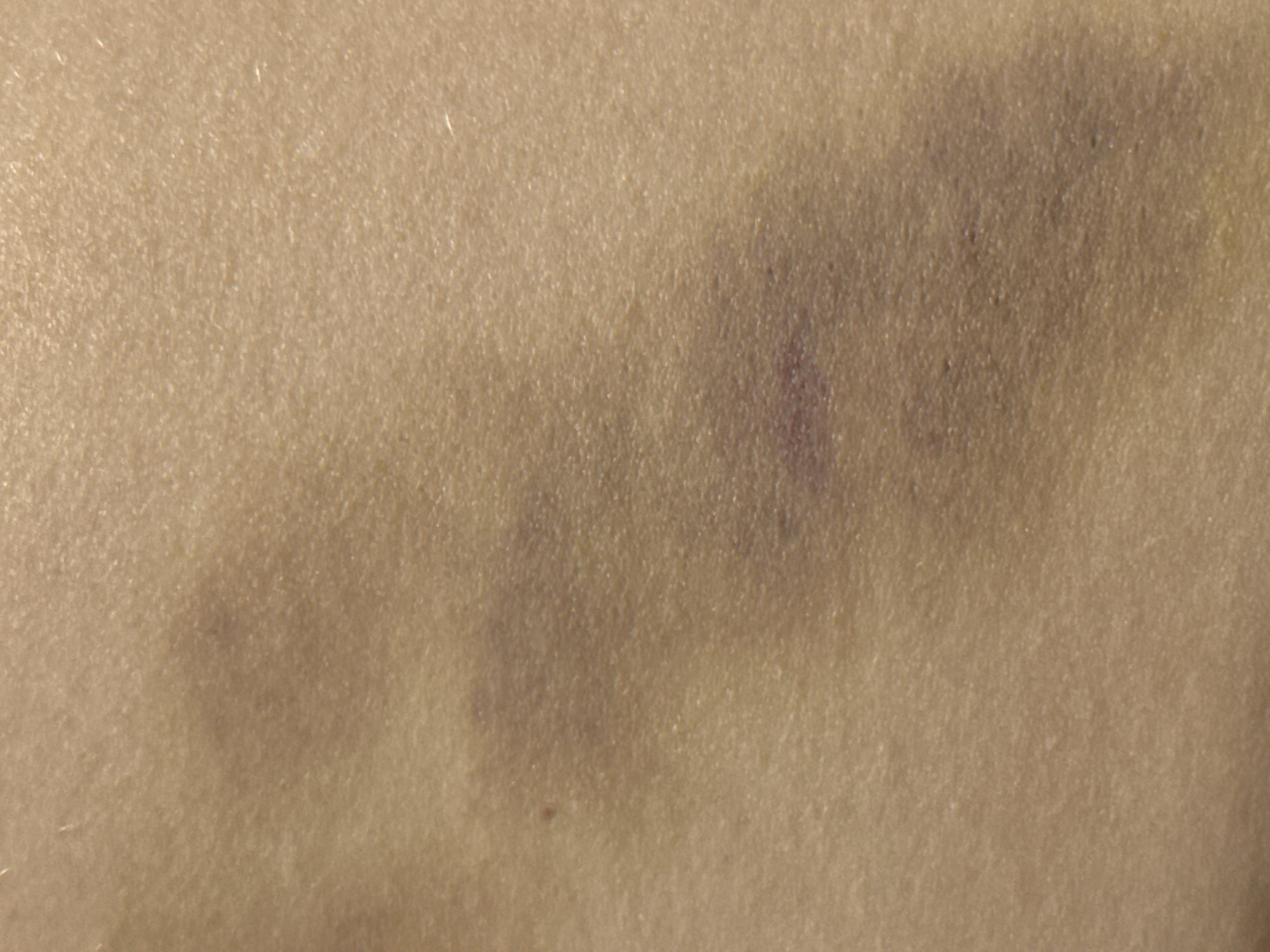 The image is a close-up of human skin exhibiting bruising. The skin tone appears light to medium. The bruises are visible as purplish and bluish discolorations, varying in intensity and size, suggesting recent or healing trauma. The texture of the skin, with its pores and slight variations in surface, is discernible. There are no other objects or environmental features visible in the image. The location of this image in Budva, Montenegro, cannot be determined from the visual information provided.