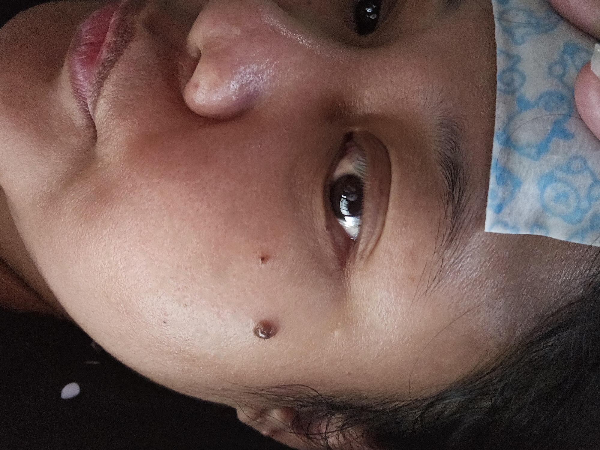 A close-up, waist-up, frontal shot shows a person's face, predominantly the left side, with a portion of their forehead and hair visible. The person's skin appears to be of a medium complexion with some texture. A small, dark mole is visible on their cheek, slightly below and to the right of their eye, and another smaller, flatter mole is present on the cheekbone. A white facial mask with a blue pattern is adhered to the upper left part of the forehead. The eye is open and looking towards the camera, with visible eyelashes and eyebrow. The nose is slightly tilted, and the lips are closed and slightly parted. The lighting is soft, with reflections visible in the eye. The background is dark and out of focus, with a small white circular object visible on the right side. There are no discernible features that suggest a specific location in Jenu, Indonesia.