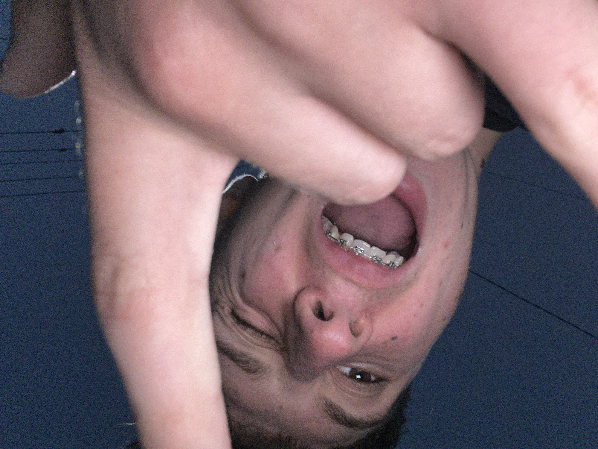 A young individual's face is captured in an upward-angled close-up, featuring an open mouth with visible upper and lower teeth. Silver dental braces are clearly present on the upper teeth. The person's right eye, with a visible brown iris, is open, while the left eye appears mostly closed or squinting. The face exhibits an intense expression, with wrinkles on the forehead and around the eyes, indicative of shouting or yelling. Moles or blemishes are present on the cheek and nose. Two hands, appearing to belong to the subject, are partially raised and blurred in the foreground, framing or reaching towards the face. The background is an undifferentiated, grainy dark blue, offering no discernible environmental features or landmarks that could specify a location within Zlatograd, Bulgaria, or any other geographical area. Faint, dark vertical lines, possibly wires, are visible in the upper left quadrant of the background. The lighting appears dim, contributing to the grainy texture of the image.