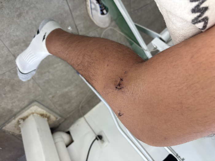 An image shows a person's lower leg with a white sock and an ankle that has been stitched in two different places. The stitches appear to be freshly done, with the suture material still visible. The background includes a tiled floor, part of a white metal frame, and a glimpse of another shoe. The overall setting suggests a medical or clinical environment.